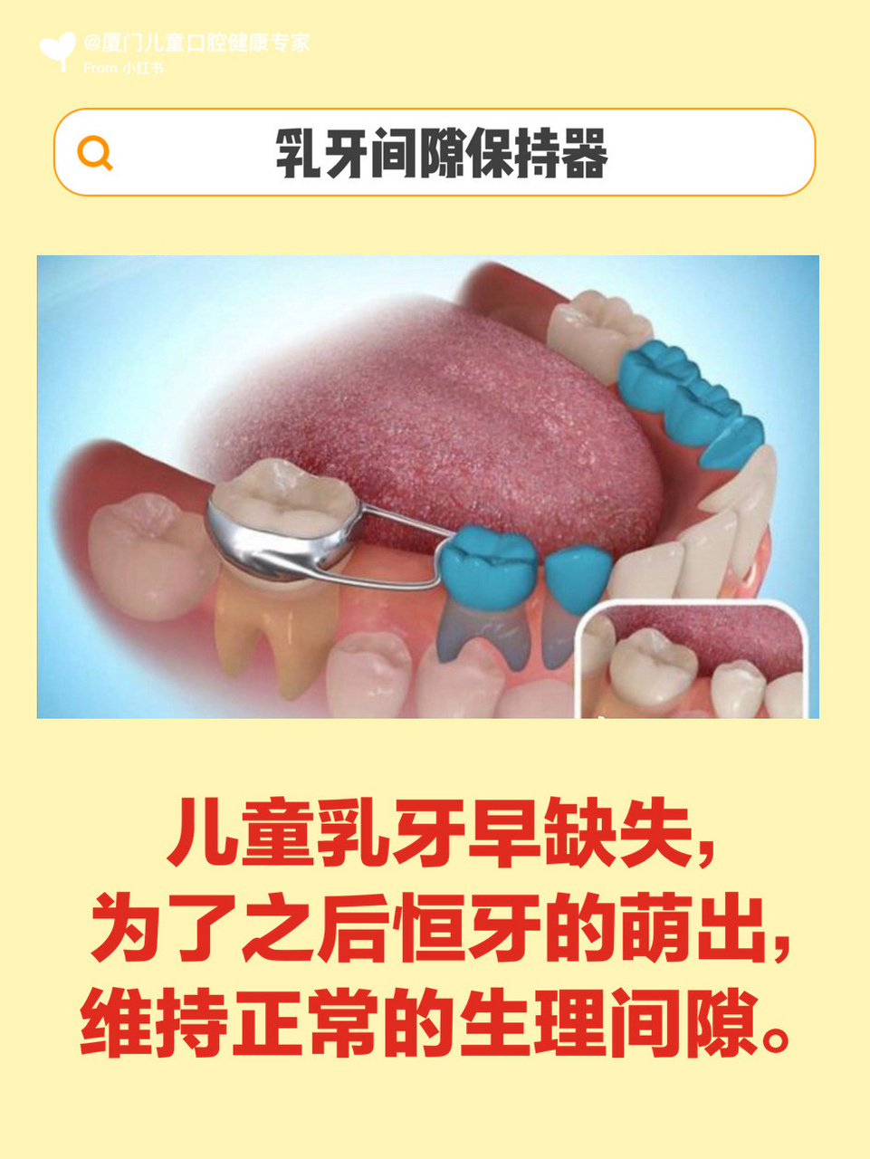 孩子牙齿|有时候,保持,也是一种治疗方式 间隙保持器:儿童乳牙早缺失