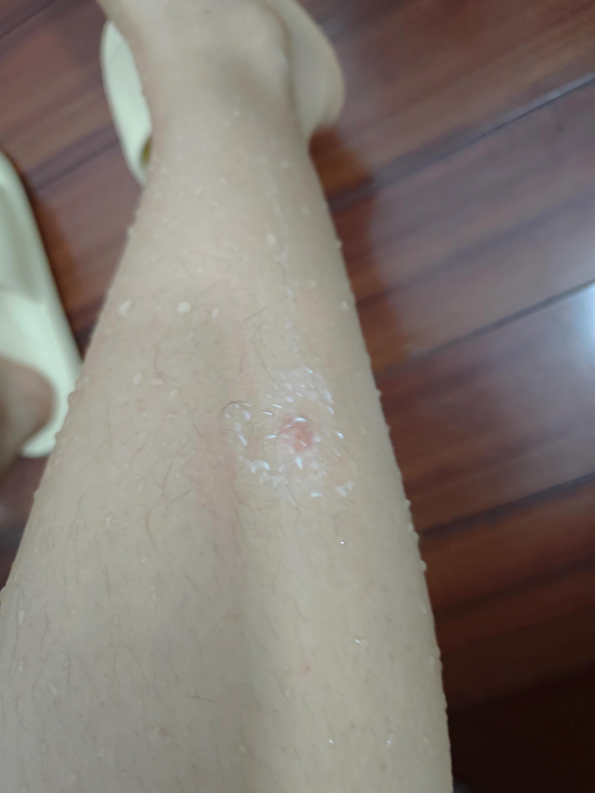  广州蚊子咬的包一直痒(被蚊子咬然后包一直痒不消)