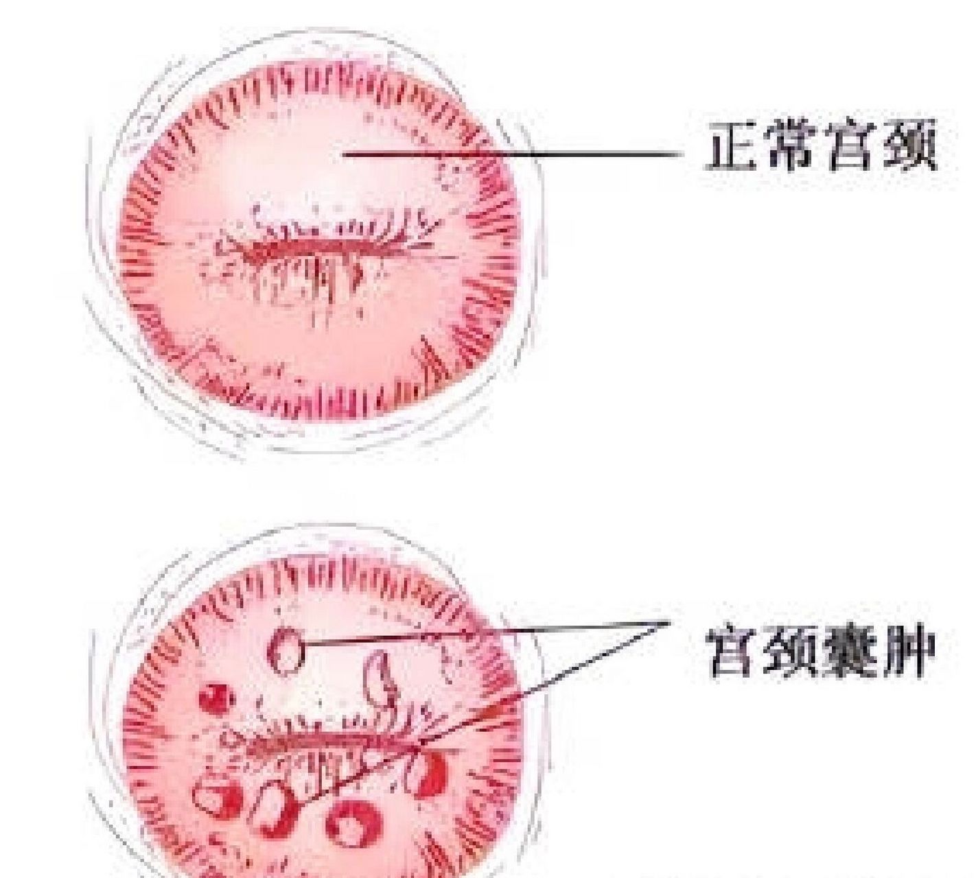 宫颈纳囊图片针刺图片