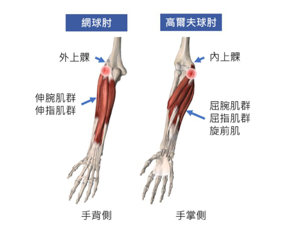 肱骨内上髁炎的治疗图片