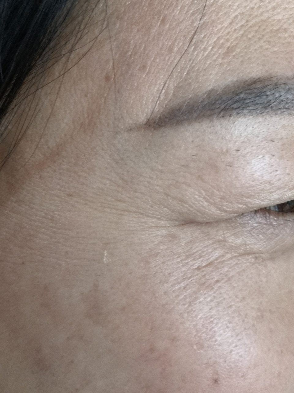 眼角纹抬头纹鼻背纹眉间纹.可以使用药物注射除皱治疗.