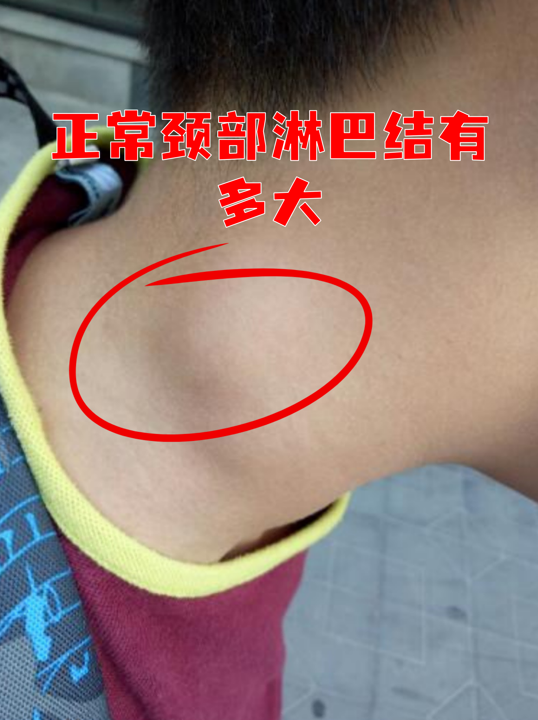 正常颈部淋巴结有多大