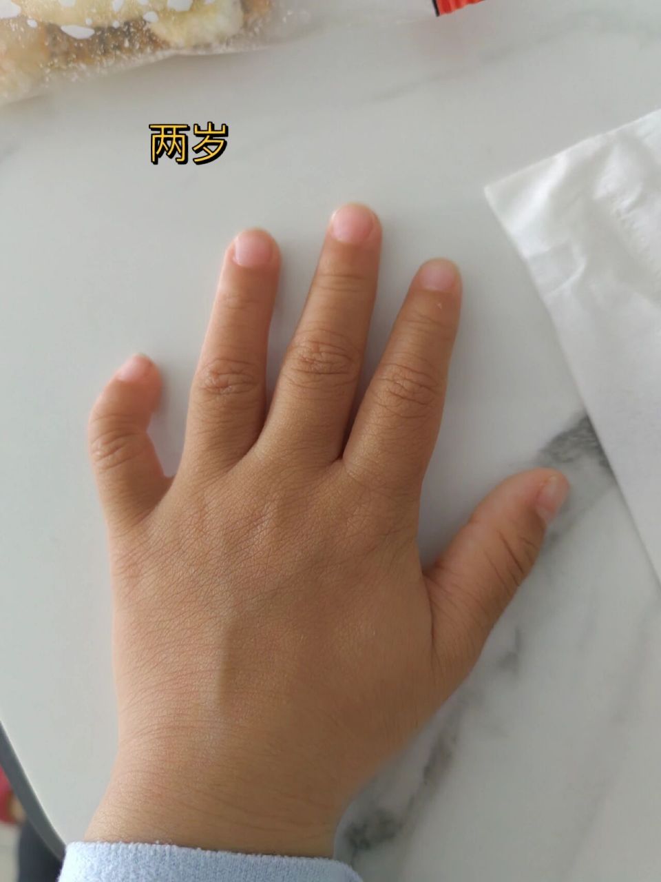 宝宝的小指好弯曲 有没有宝妈有娃手指这样的,长大后还弯吗?