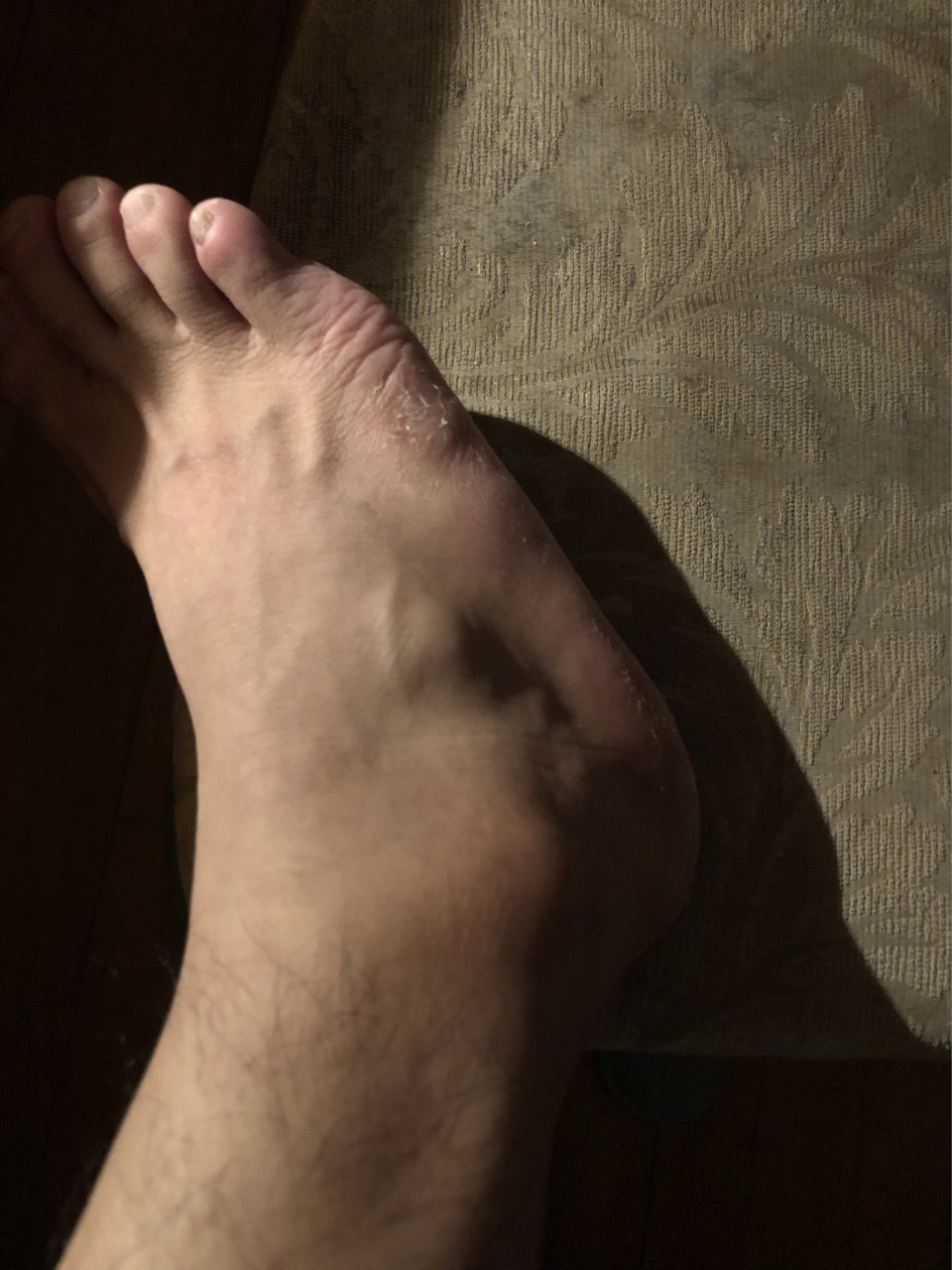"腱鞘炎",表现为关节鼓包,尽快去医院 今天跑完晚上突然发现右脚背