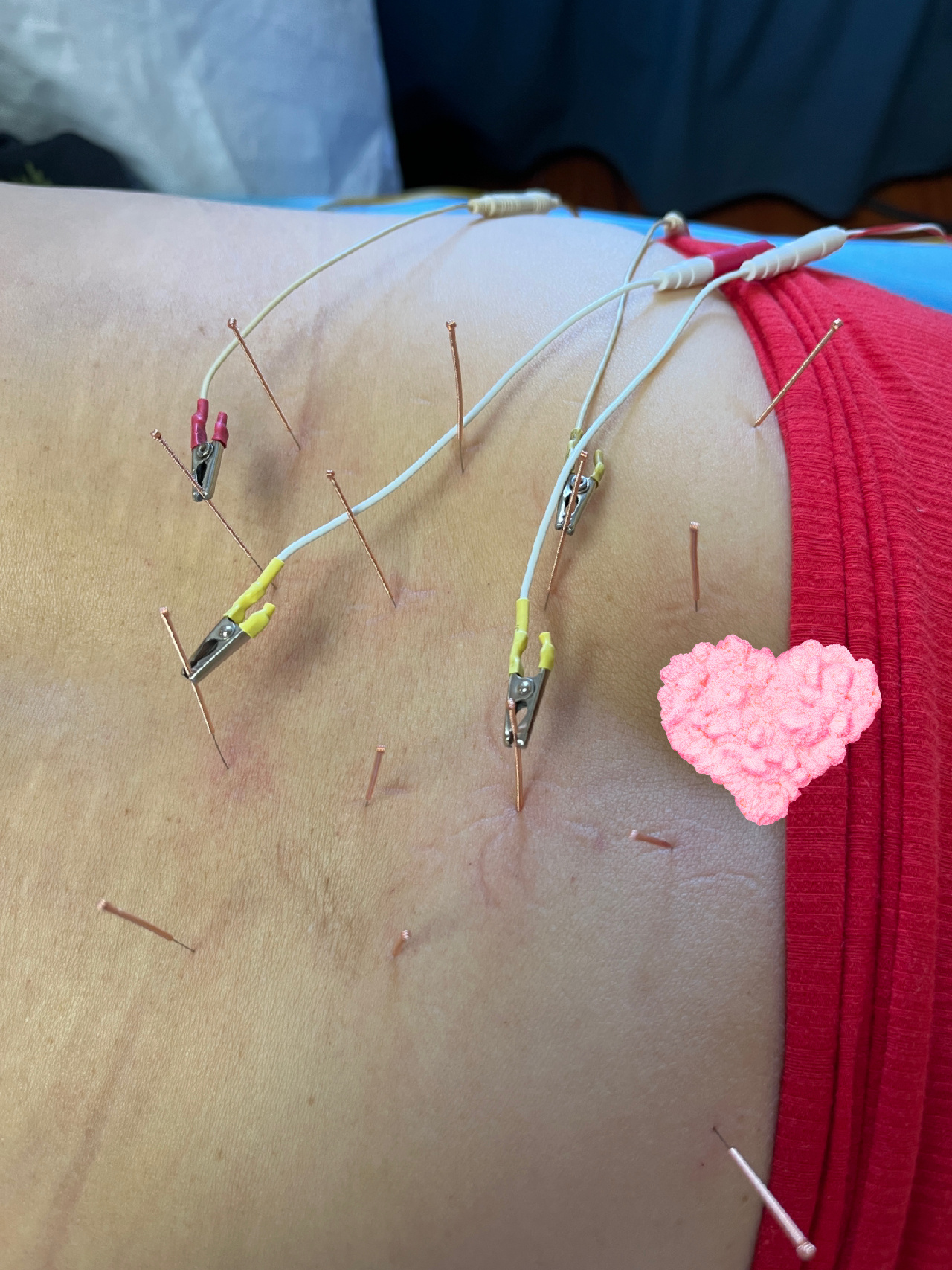 对于针灸腰痛,可能是学会(fei)了 跟着后面半年了,总结了一下嵇老师打