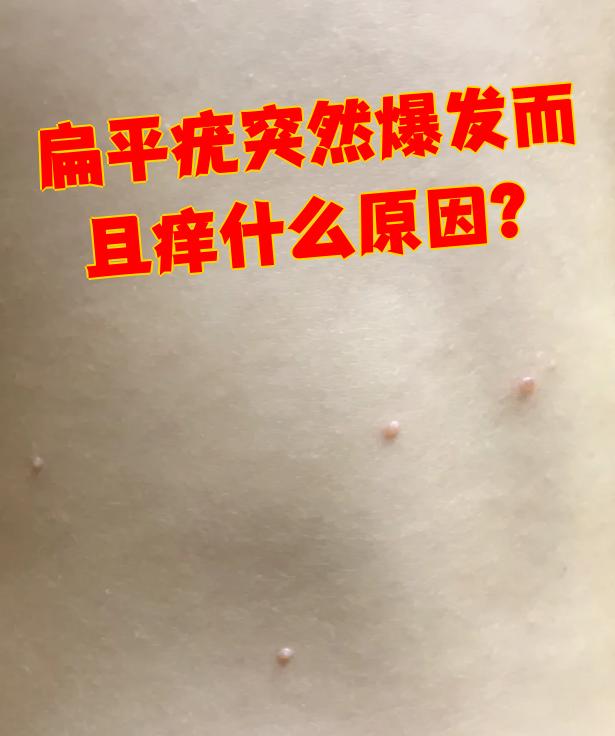 扁平疣突然爆发而且痒什么原因?