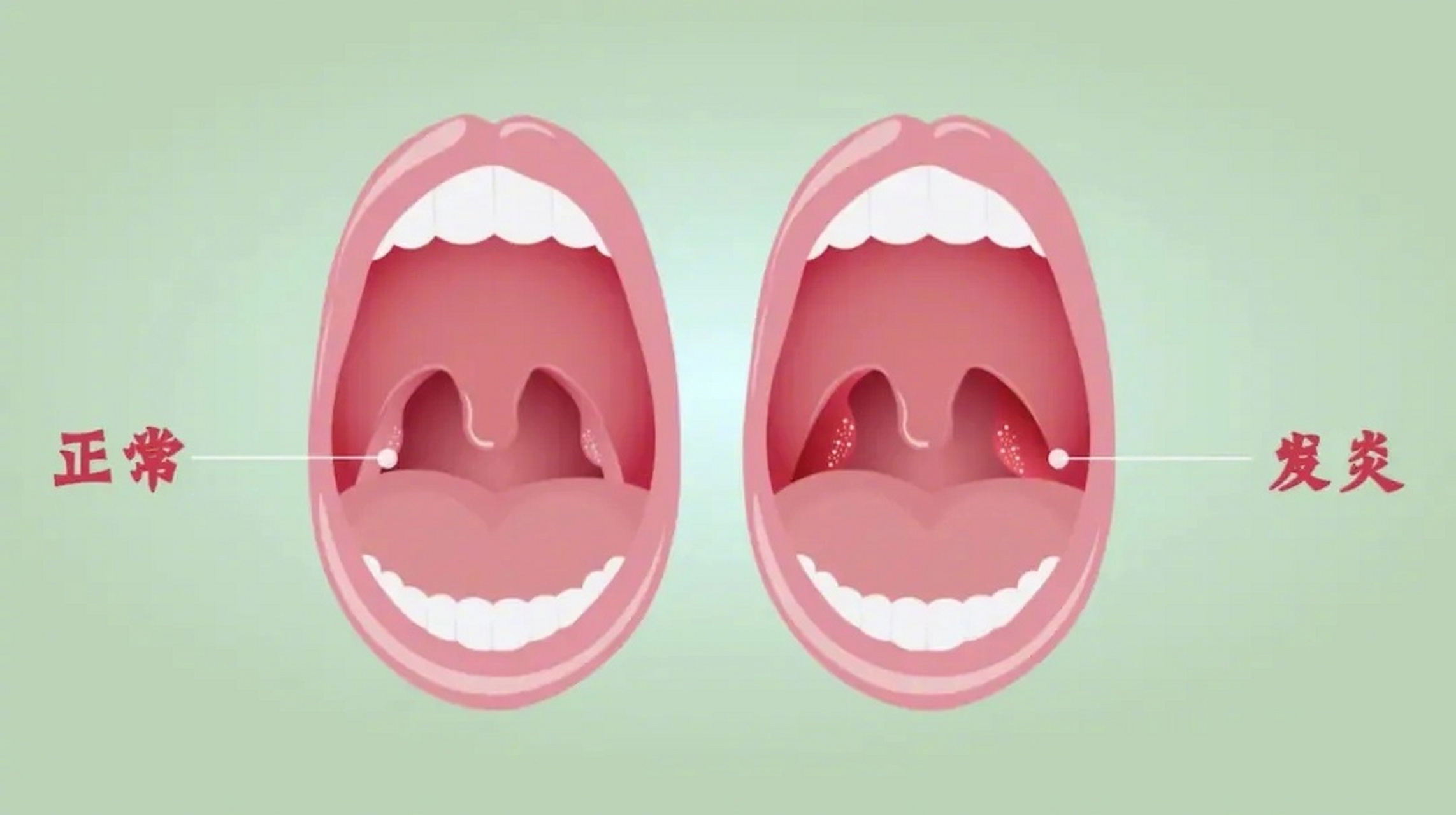 【经常发炎的扁桃体可以切吗】扁桃体之所以爱发炎,是因为它与空气,水