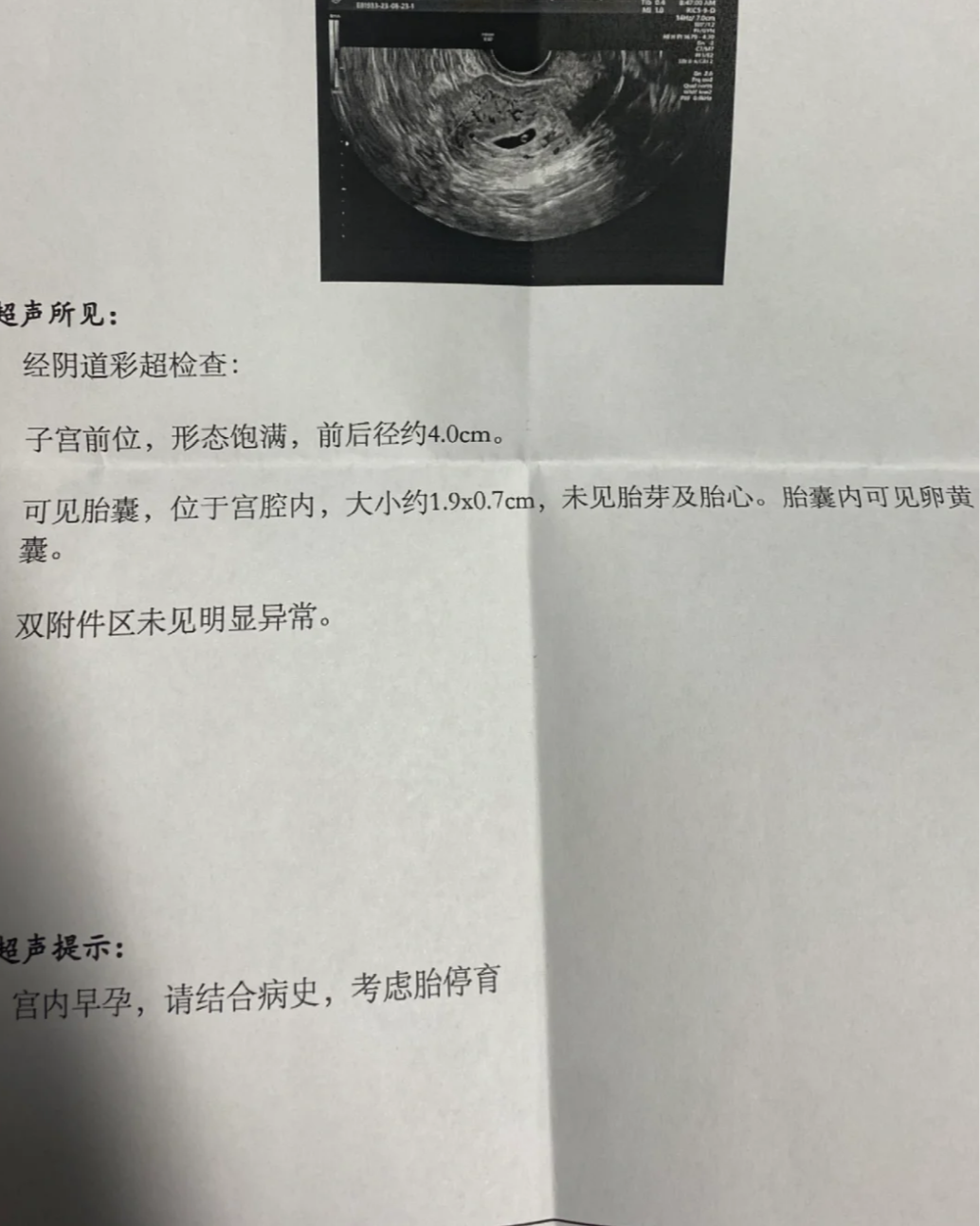 只有胎囊没有胎芽,最常见的原因是怀孕时间太短或者胚胎停育