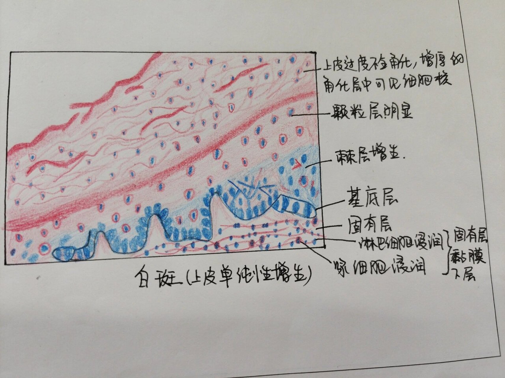 口腔组织病理学绘图 根尖肉芽肿 白斑