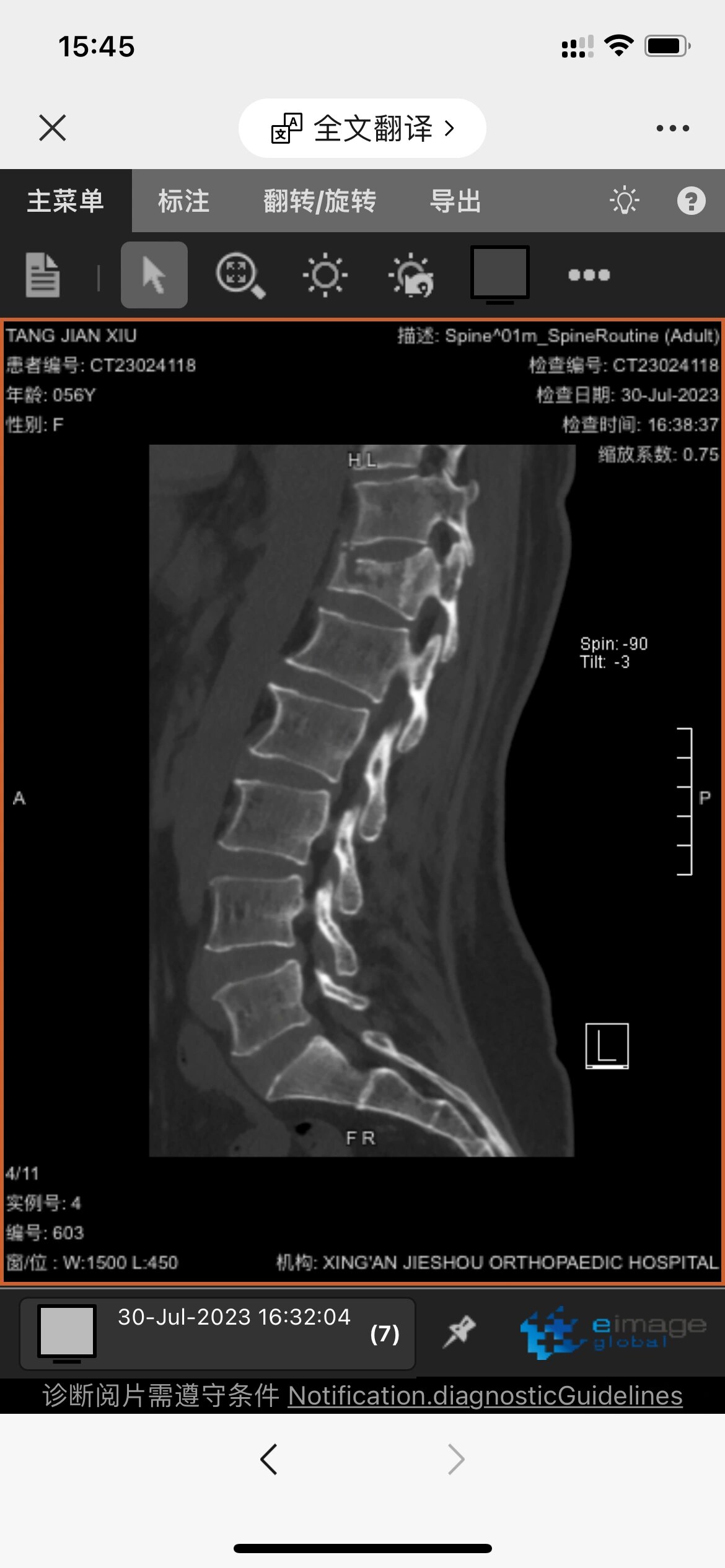 t12胸椎压缩性性骨折,需不需要手术