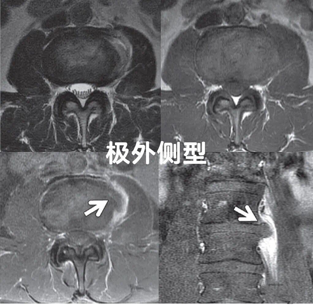 髓核凸出图片