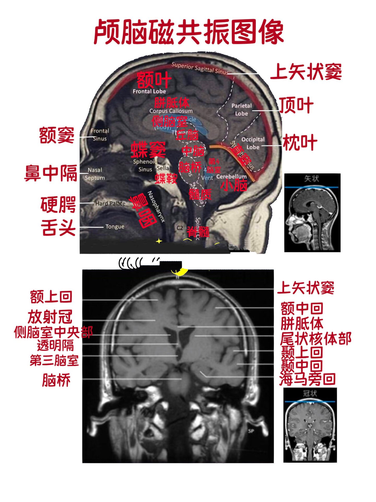 科普 63 | 颅脑磁共振图像(矢状位➕冠状位) 今天科普贴科普mri🧠