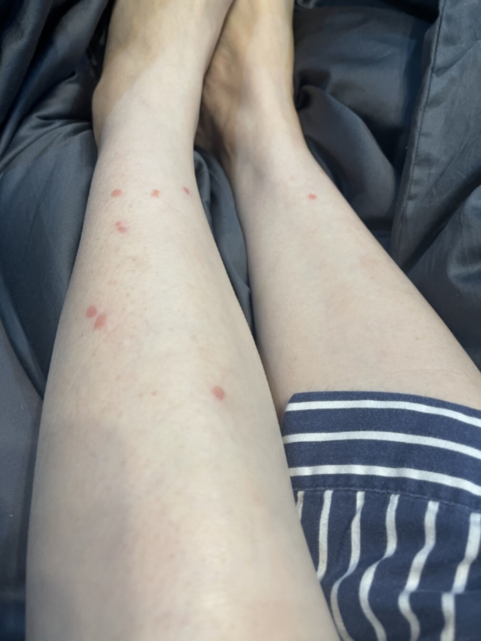 欣赏一下腿上的扁平疣