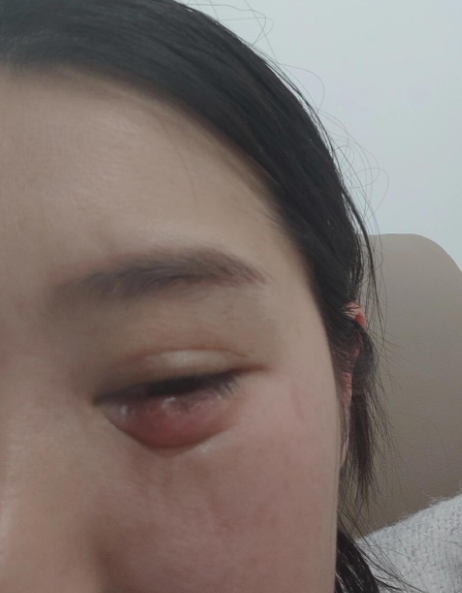 经常长麦粒肿是什么原因造成的