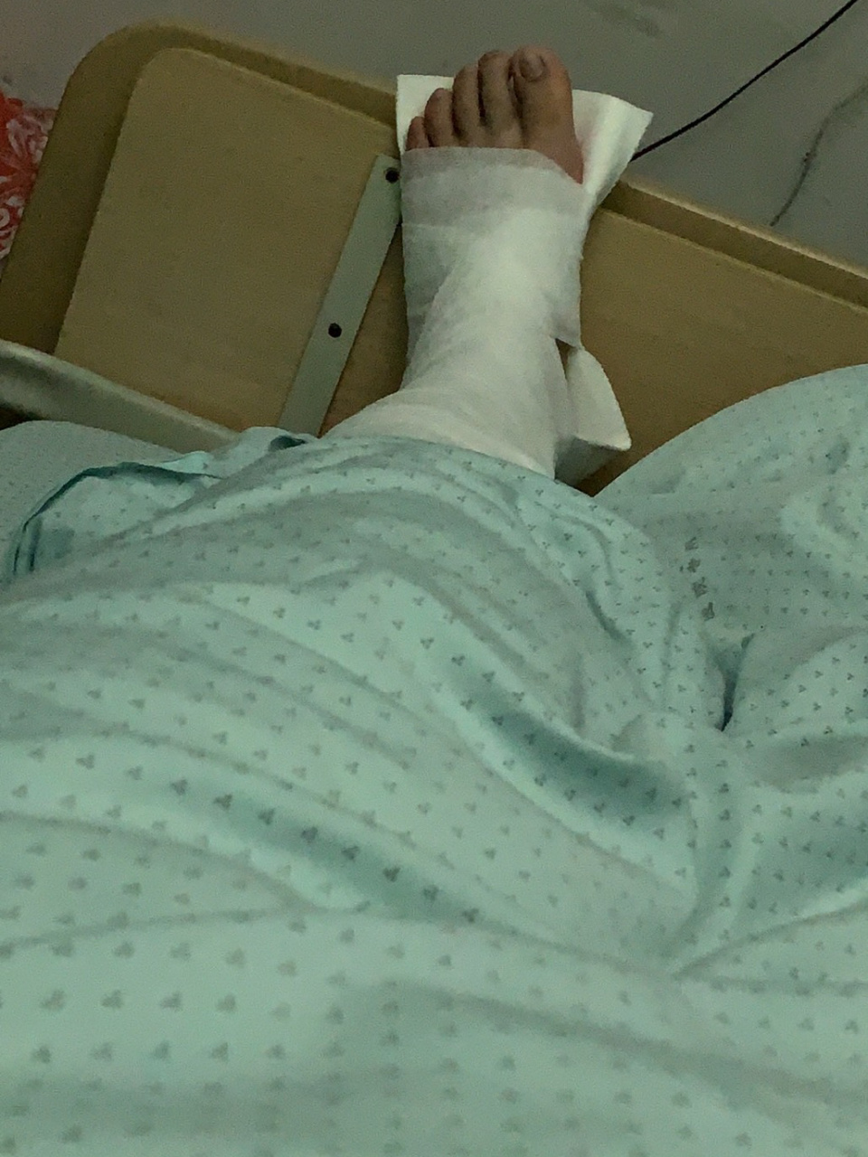 左外踝撕脱性骨折第六天 5月14号晚上八点跑步的时候时候崴了一下脚