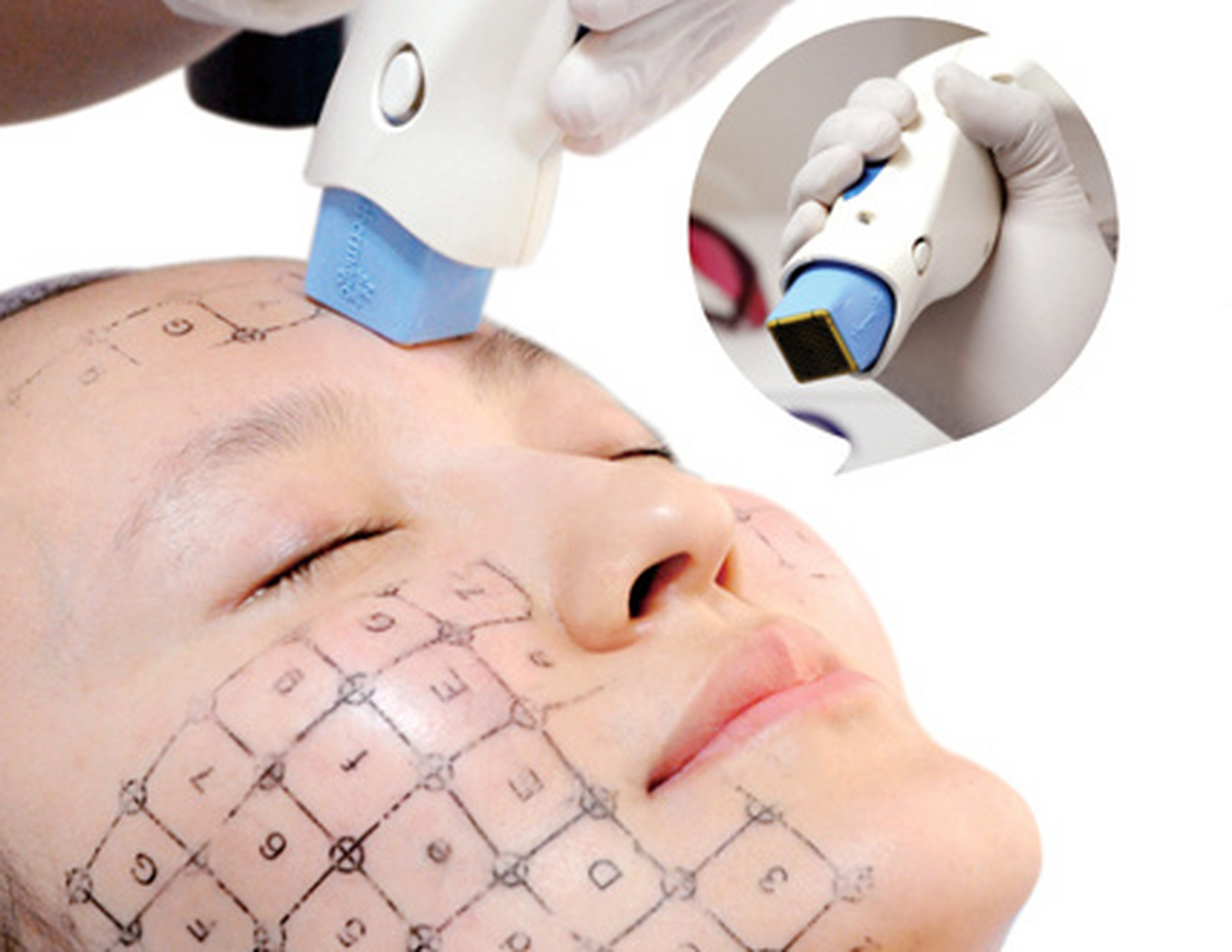 热玛吉的探头都是一次性的,这也是辨别真假热玛吉的一个办法,在做之前