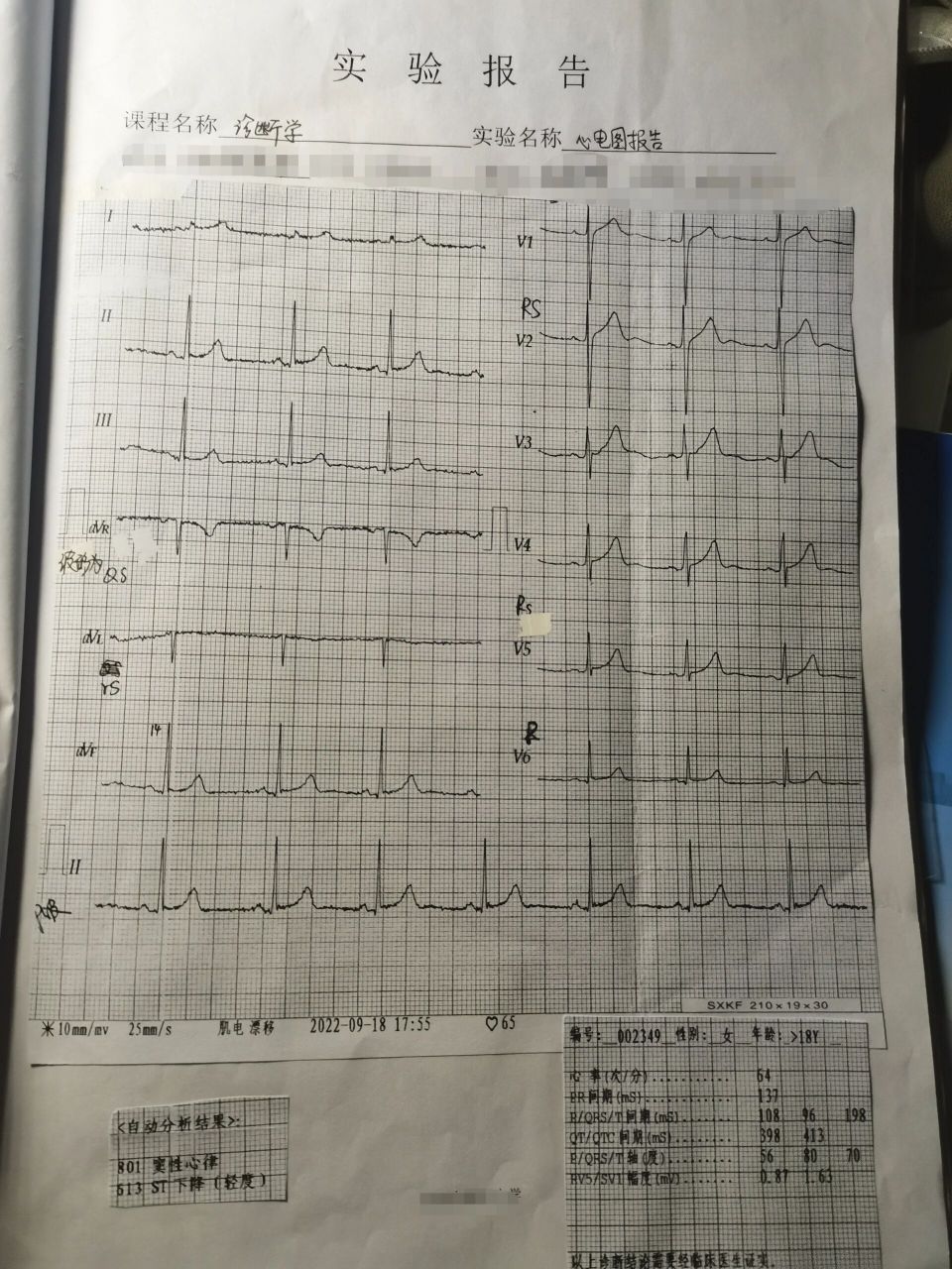 诊断学 心电图实验报告