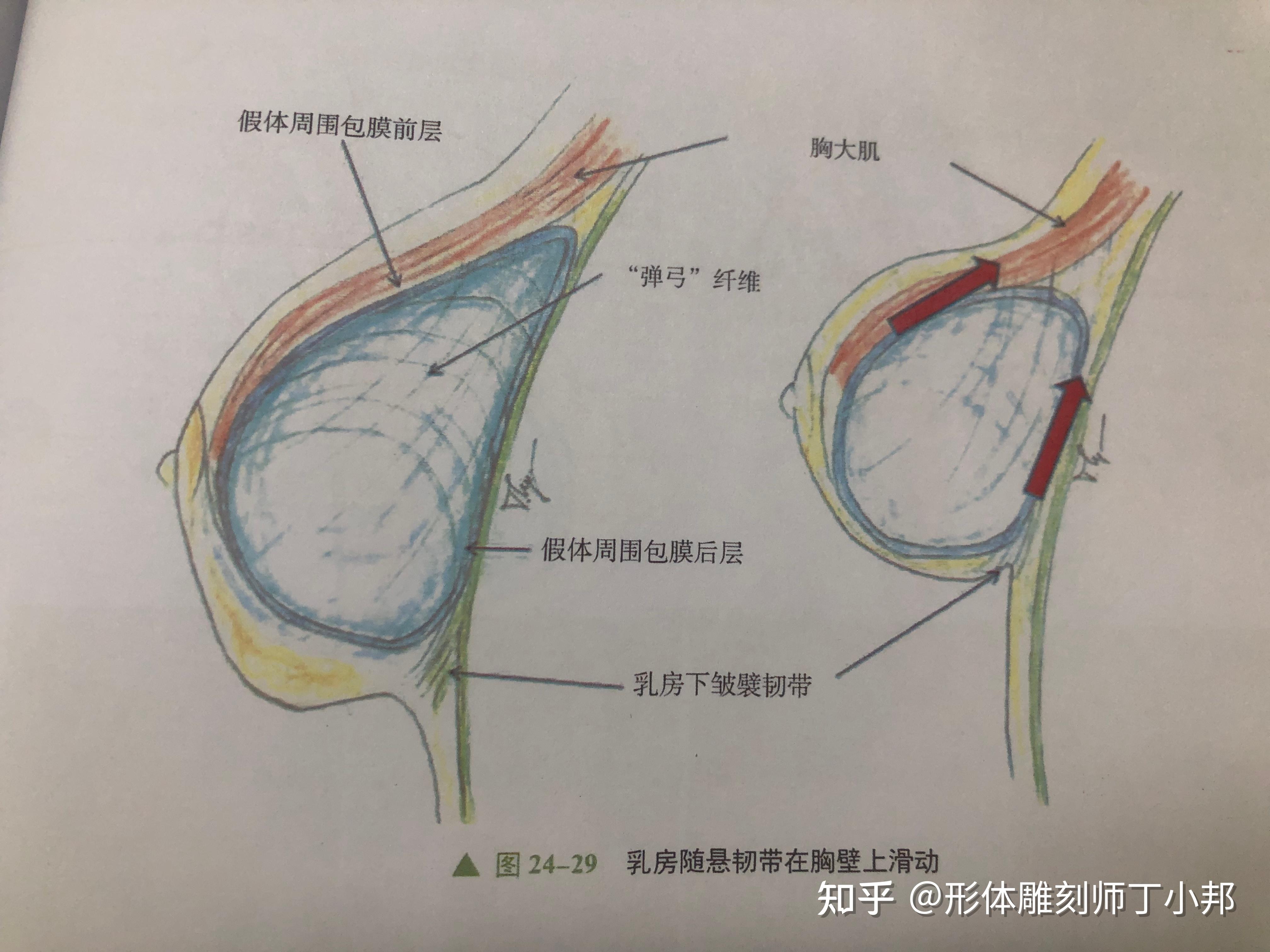 男性假体隆胸图片