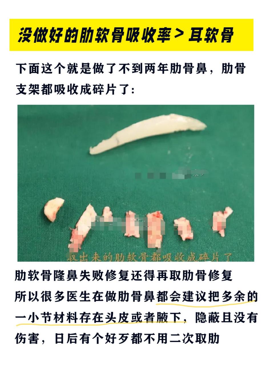 隆鼻是永久的吗隆鼻能维持多久隆鼻一定会返修吗隆鼻老了会怎样?