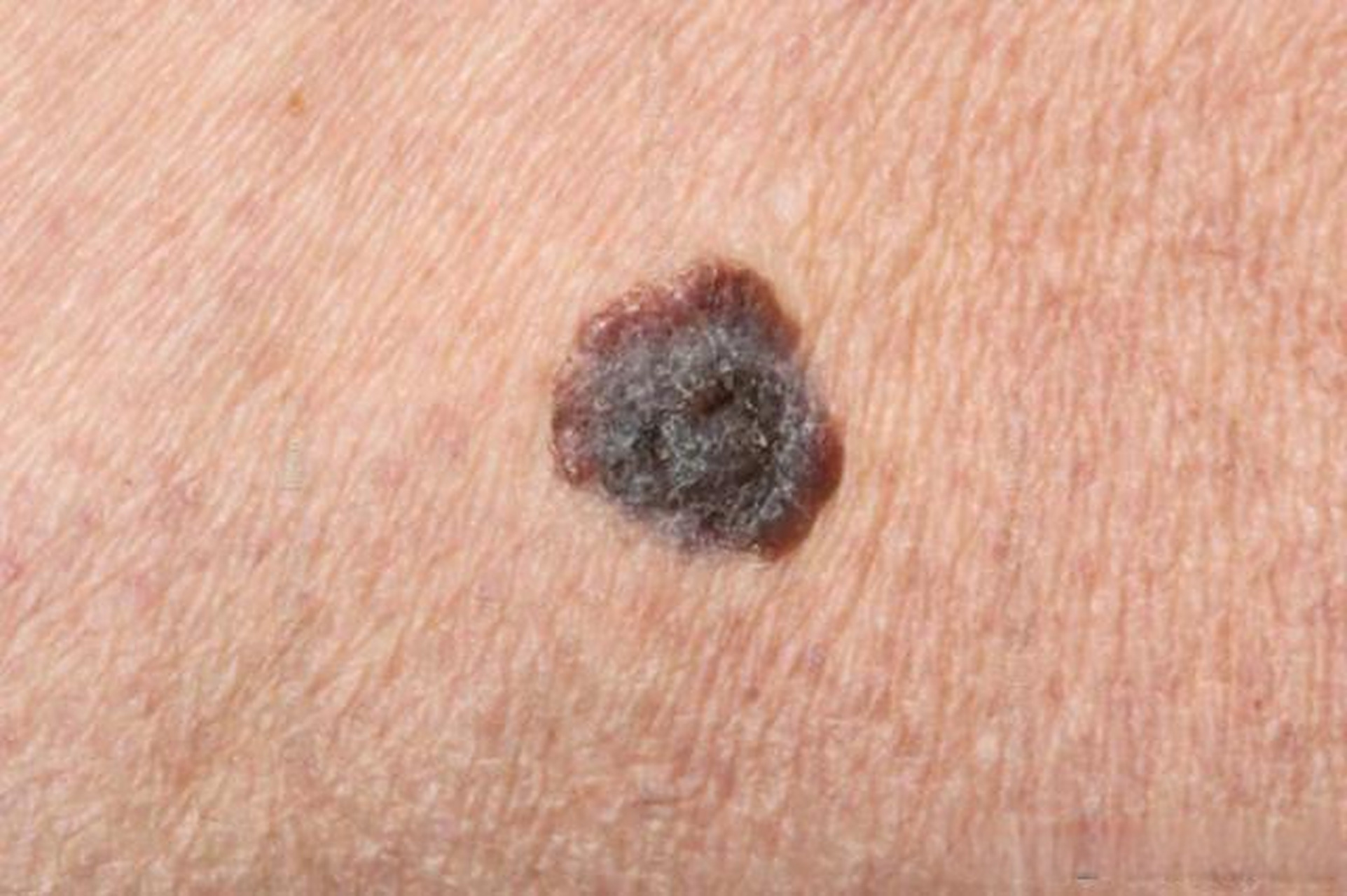 #中国好声音张恒远患黑色素瘤病逝# 著名歌手张恒远因黑色素瘤去世.  