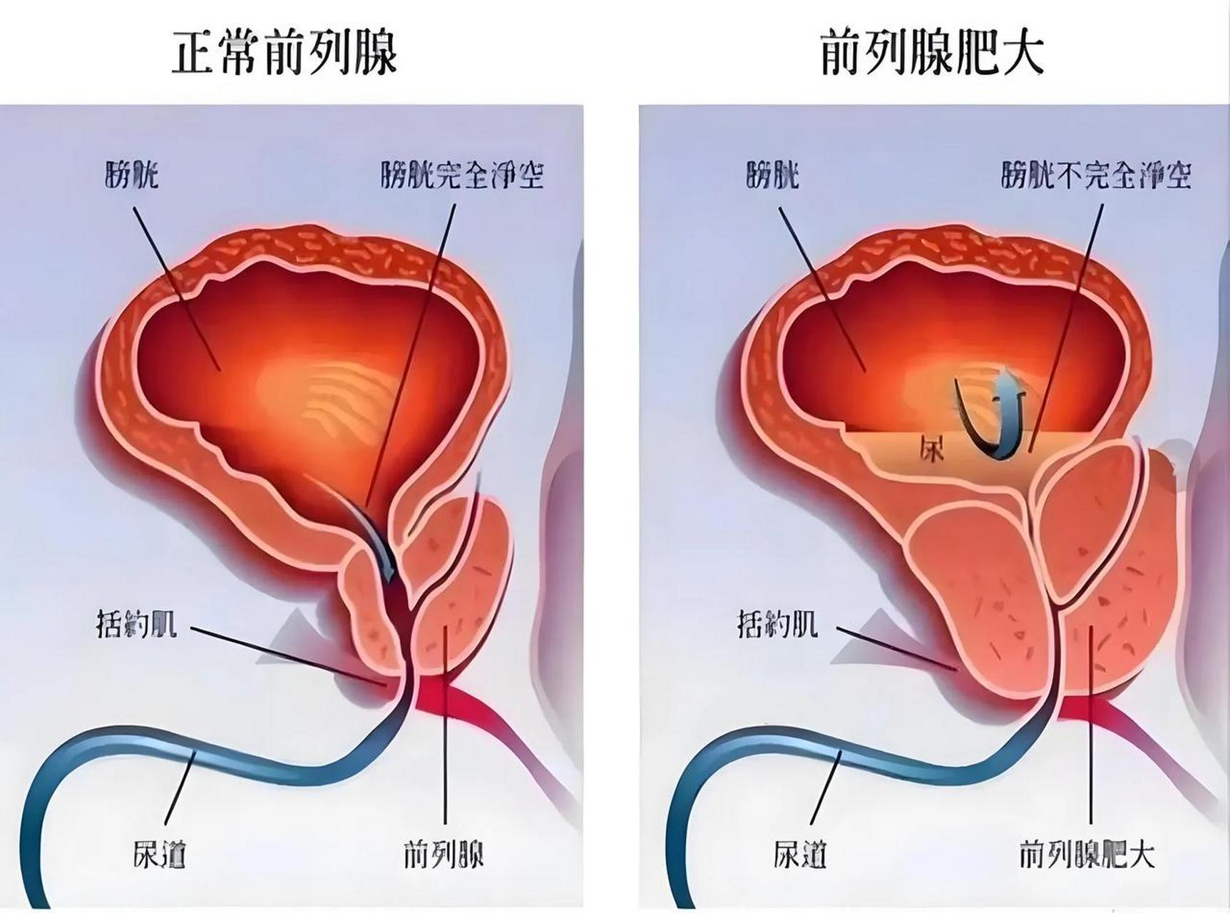 前列腺是男性生殖系统中的一个重要器官,位于膀胱下方,环绕尿道