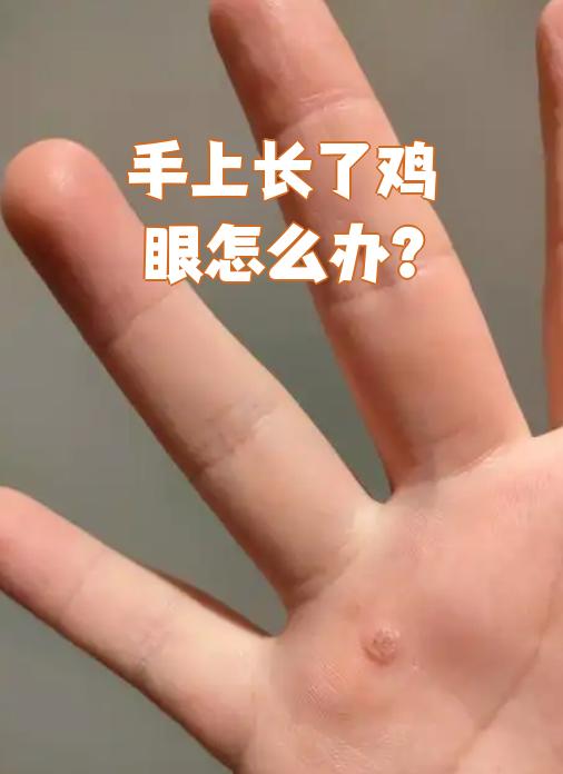 手上长鸡眼是因为皮肤长期被挤压或摩擦引起的