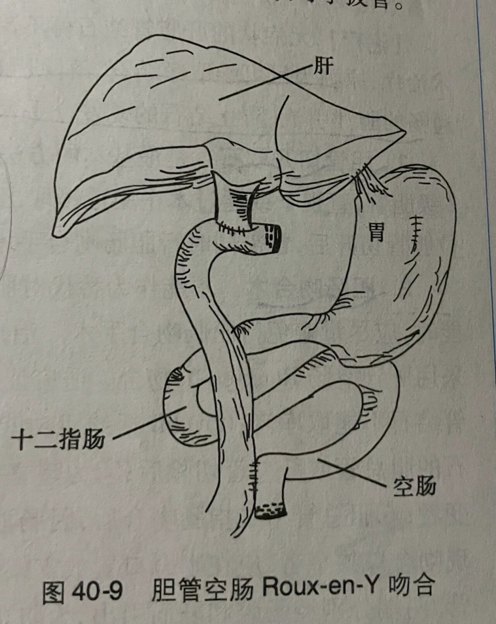 胆结石|附胆囊肝脏胰十二指肠解剖图 oddi括约肌是一组围绕胆胰管末端
