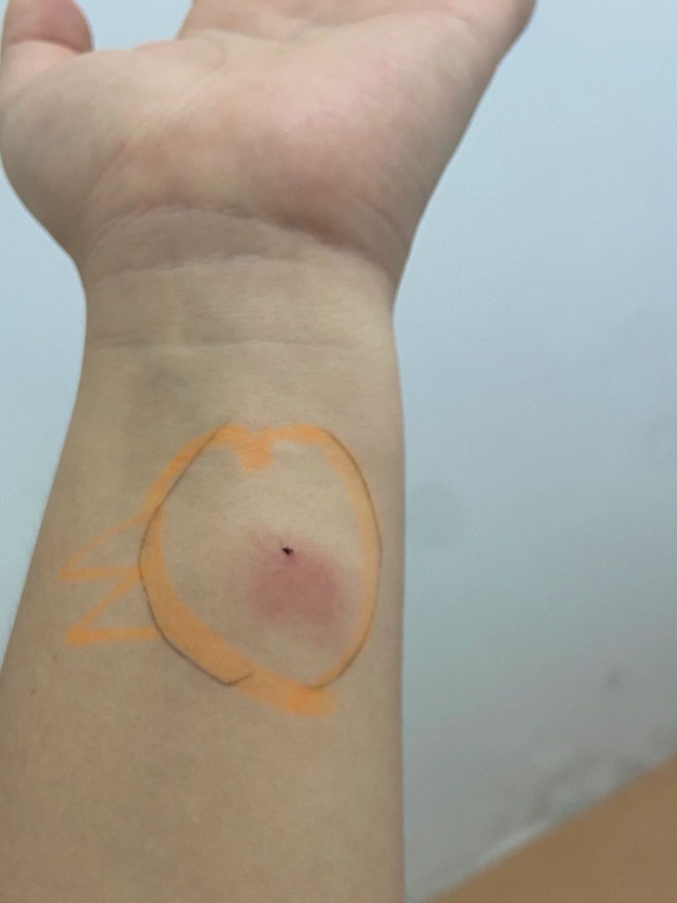 做完ppd24小时,这样子,正常么