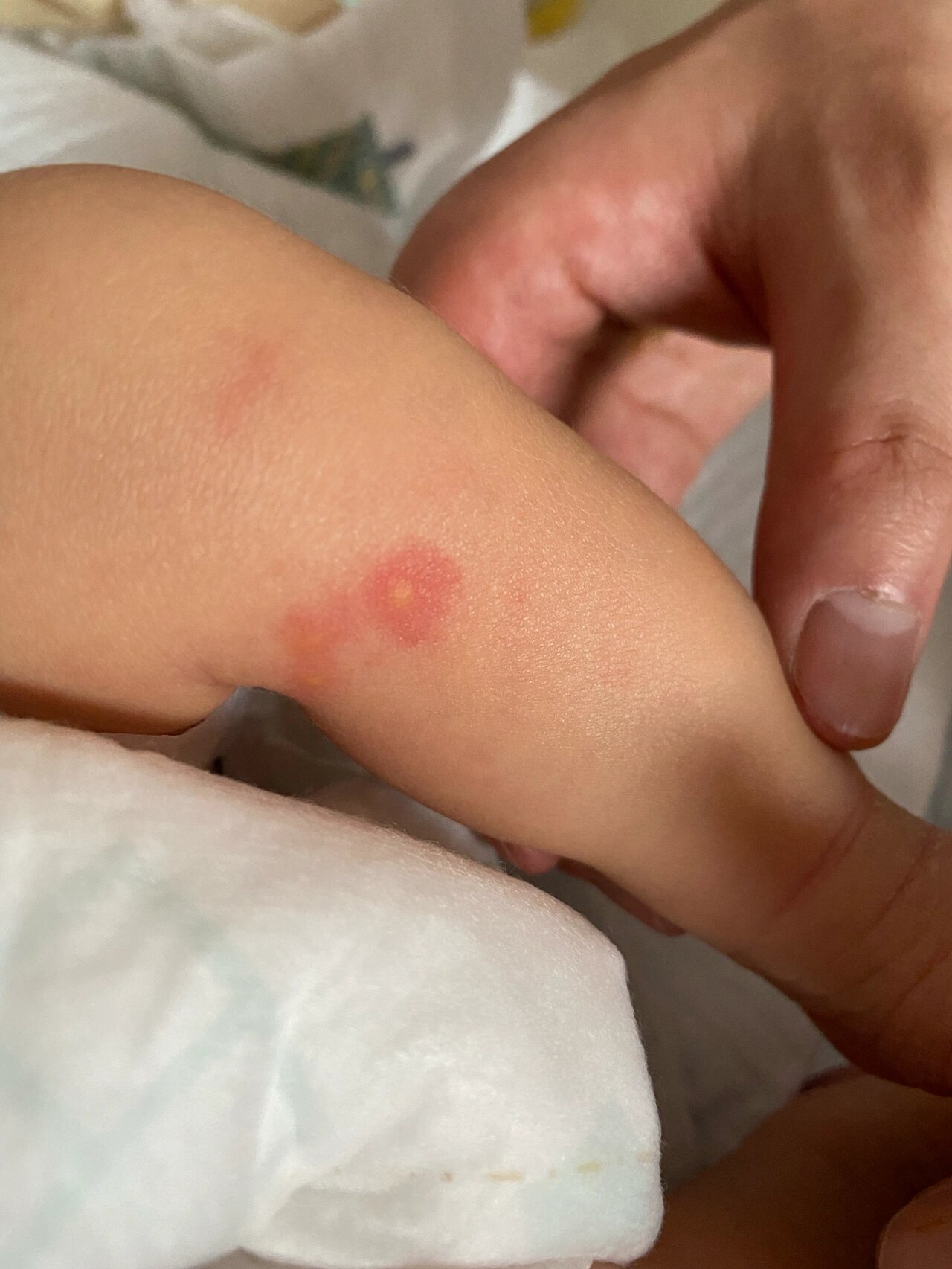 新生儿第三天腿上长这种痘痘正常吗