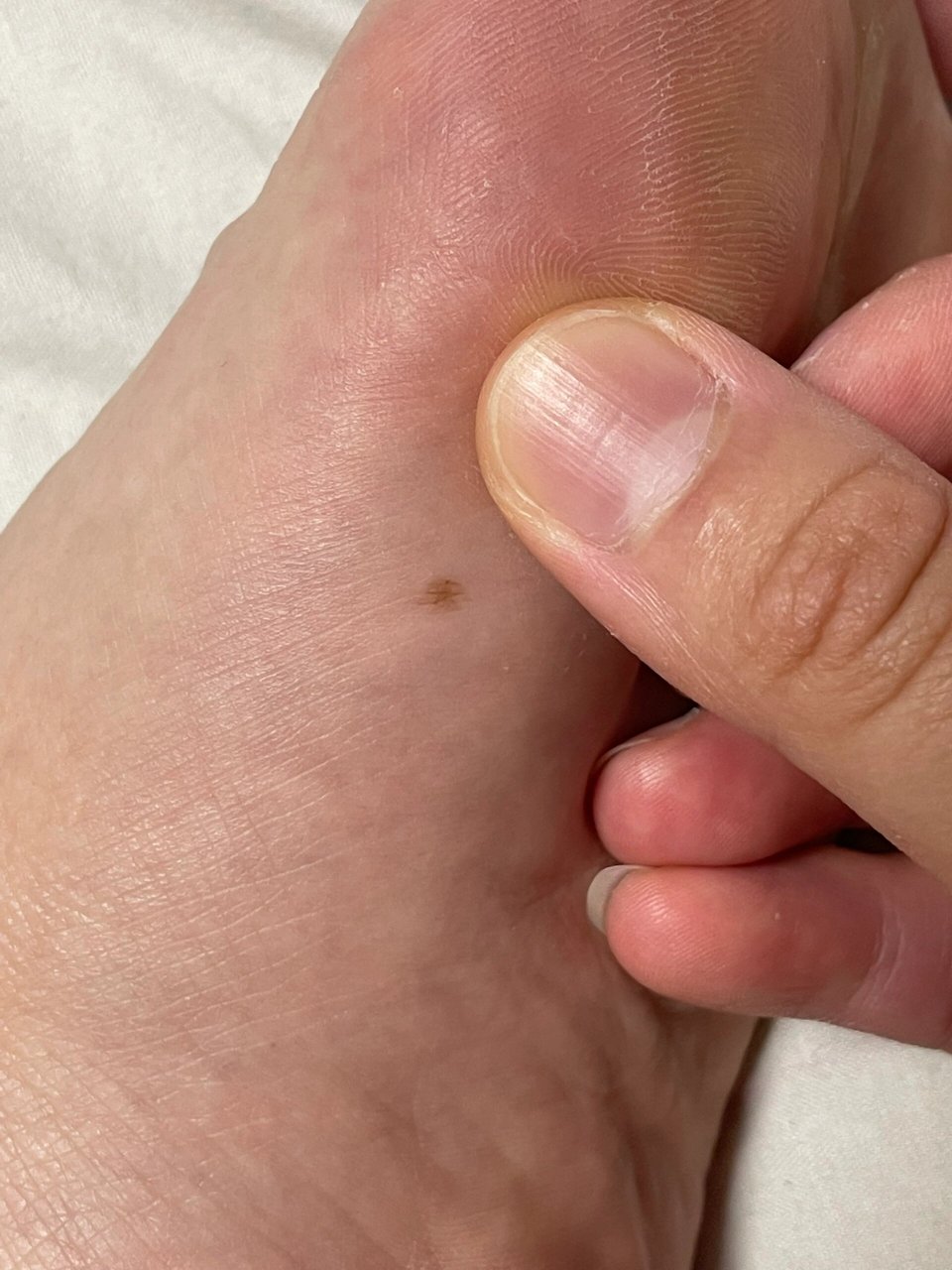 脚底痣一定要切吗?