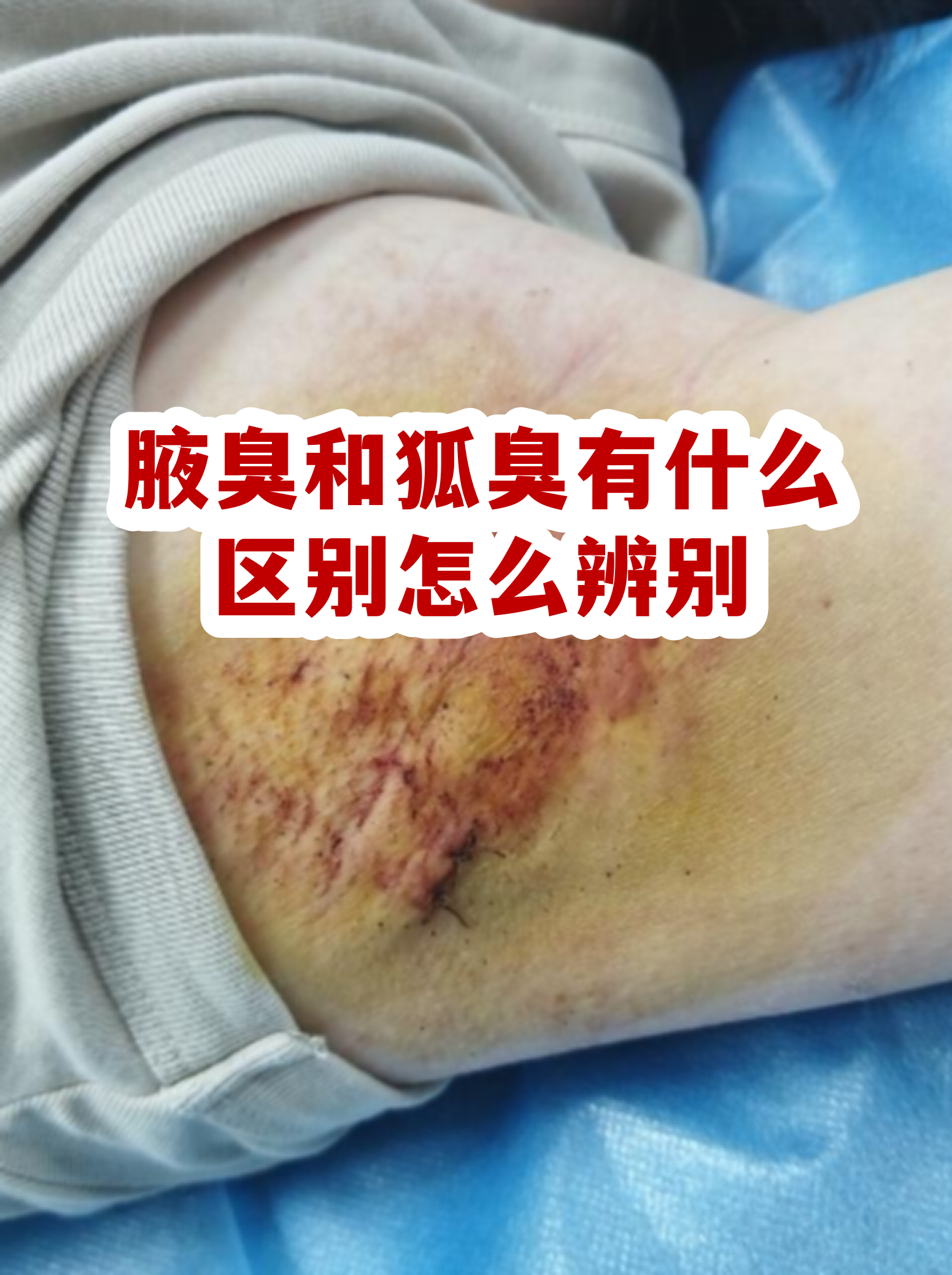 青春期假性狐臭和狐臭的区别(孩子之前没有狐臭现在突然有了)