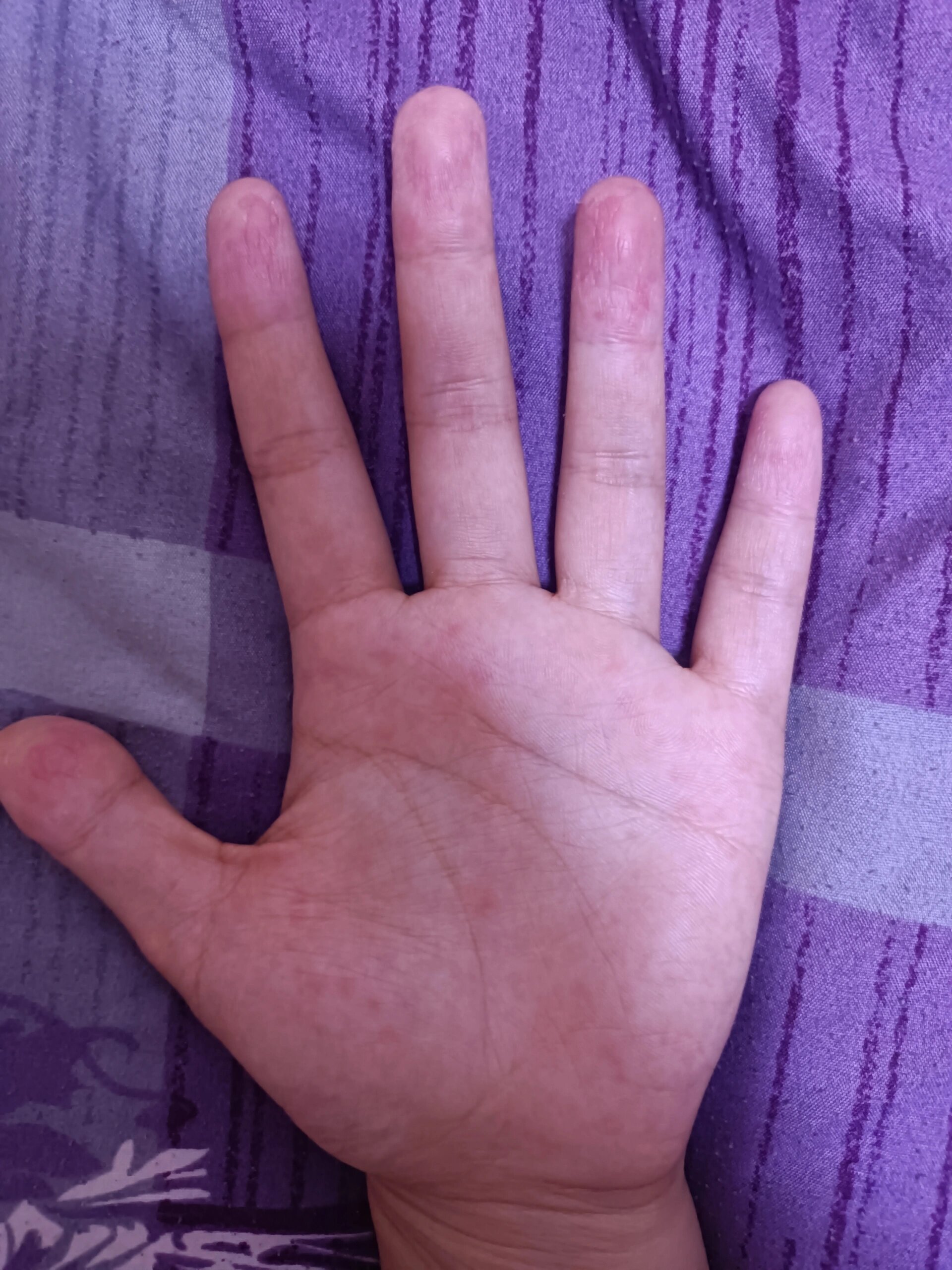 有没有人知道是咋回事,手心里面有硬硬的小疙瘩,扎扎的发痒,在肉里面