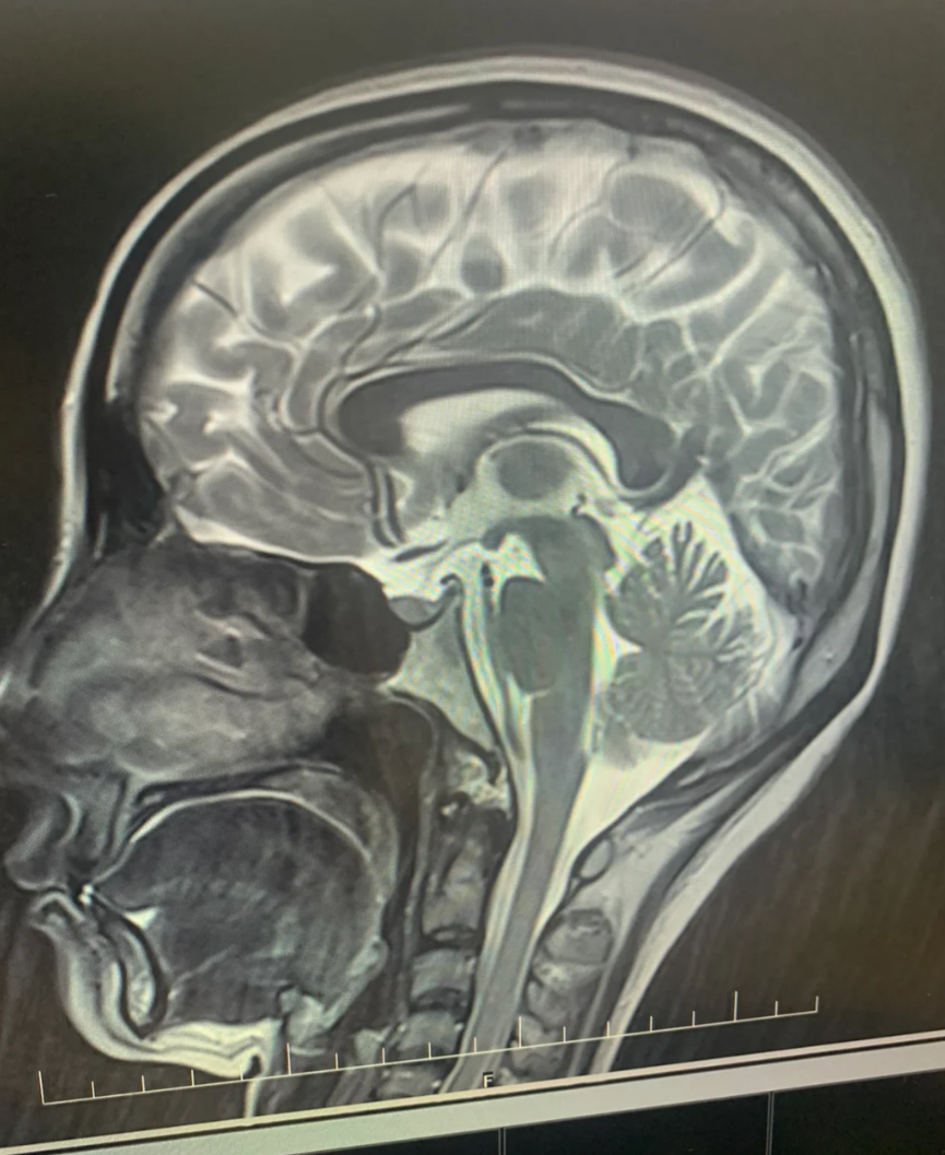 脑垂体发育不良是可以治疗的,但需要先做全面检查才能确定具体方案