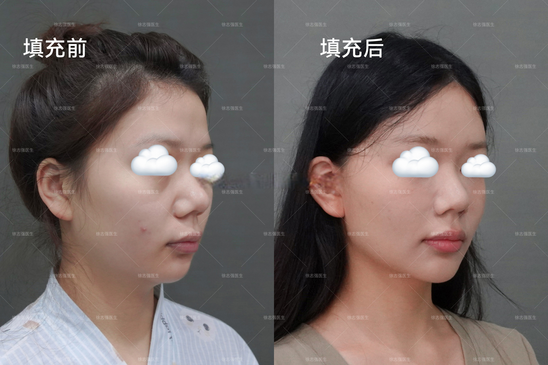 自体脂肪面部填充,术后1年 填充部位:额头,太阳穴,泪沟,颧沟,鼻基底