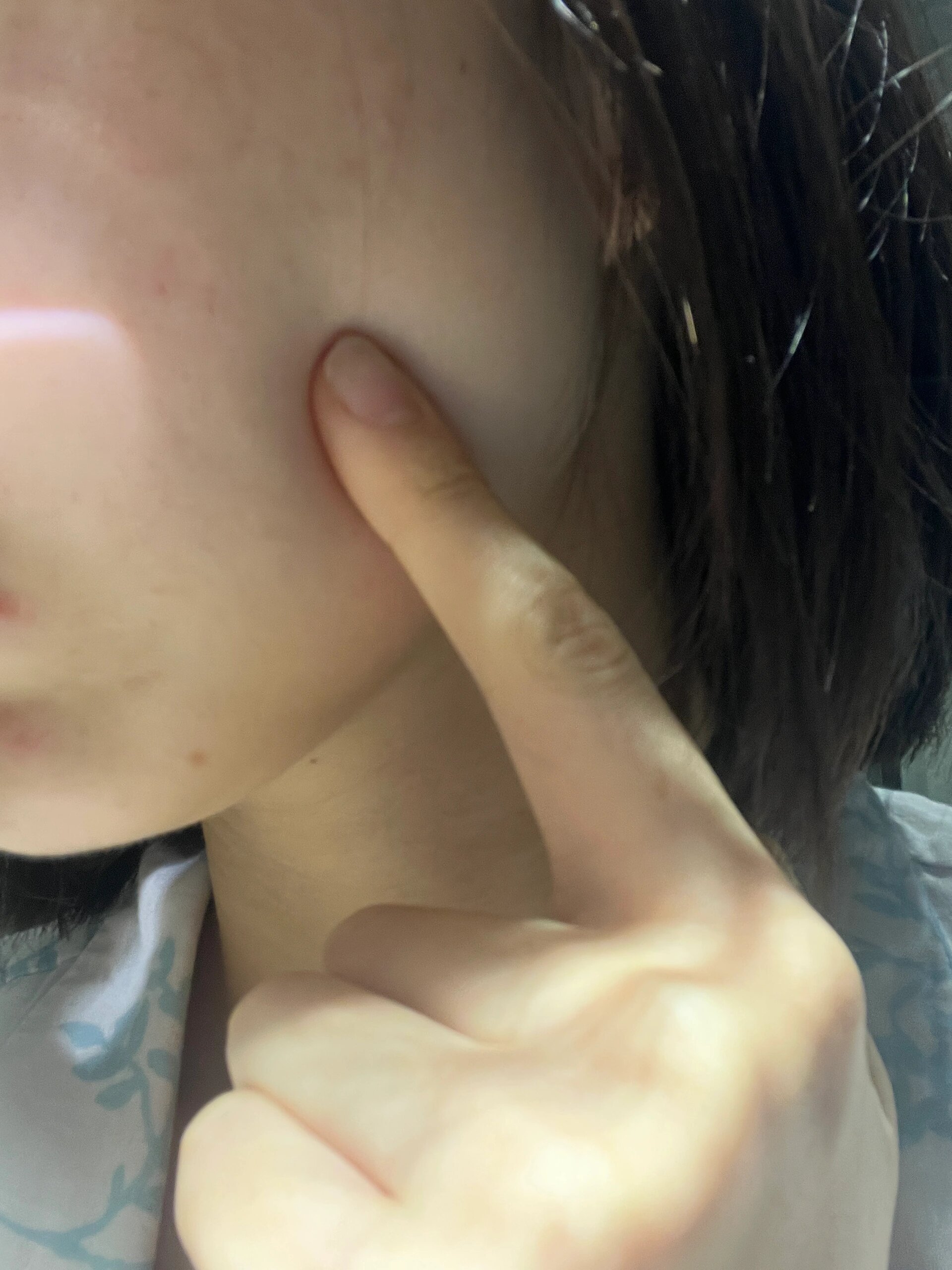 左脸内长了一个移动小圆疙瘩 是什么东西?