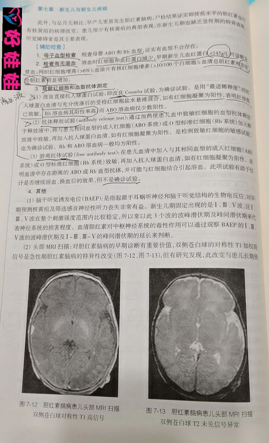 新生儿溶血病 好娃娃晚安分享 新生儿溶血病分为: ①abo溶血②rh溶血