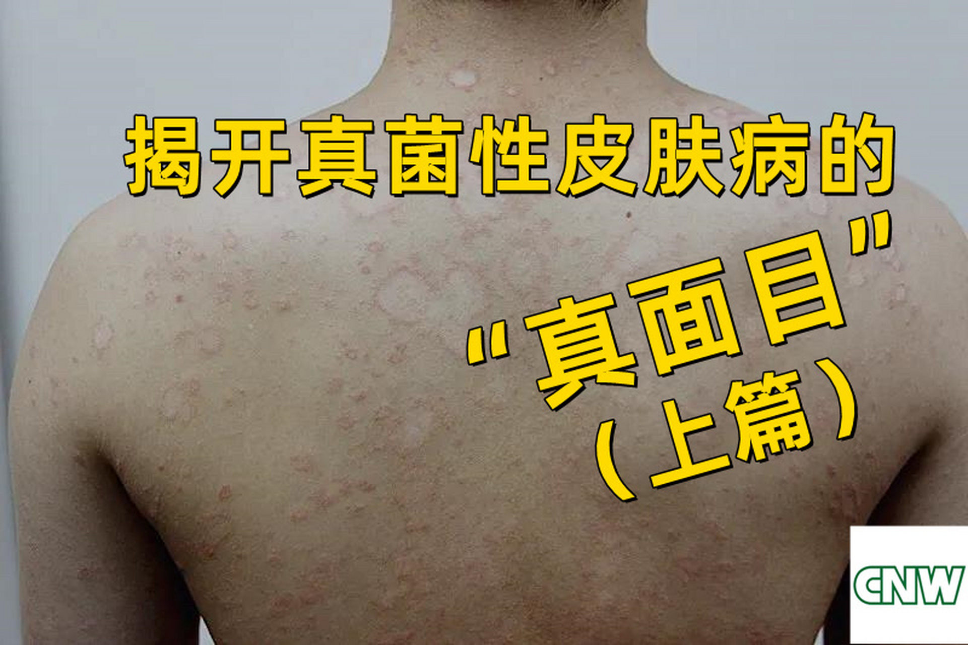 【医话】(上)揭开真菌性皮肤病的"真面目" 目前发现的真菌有7万多种.