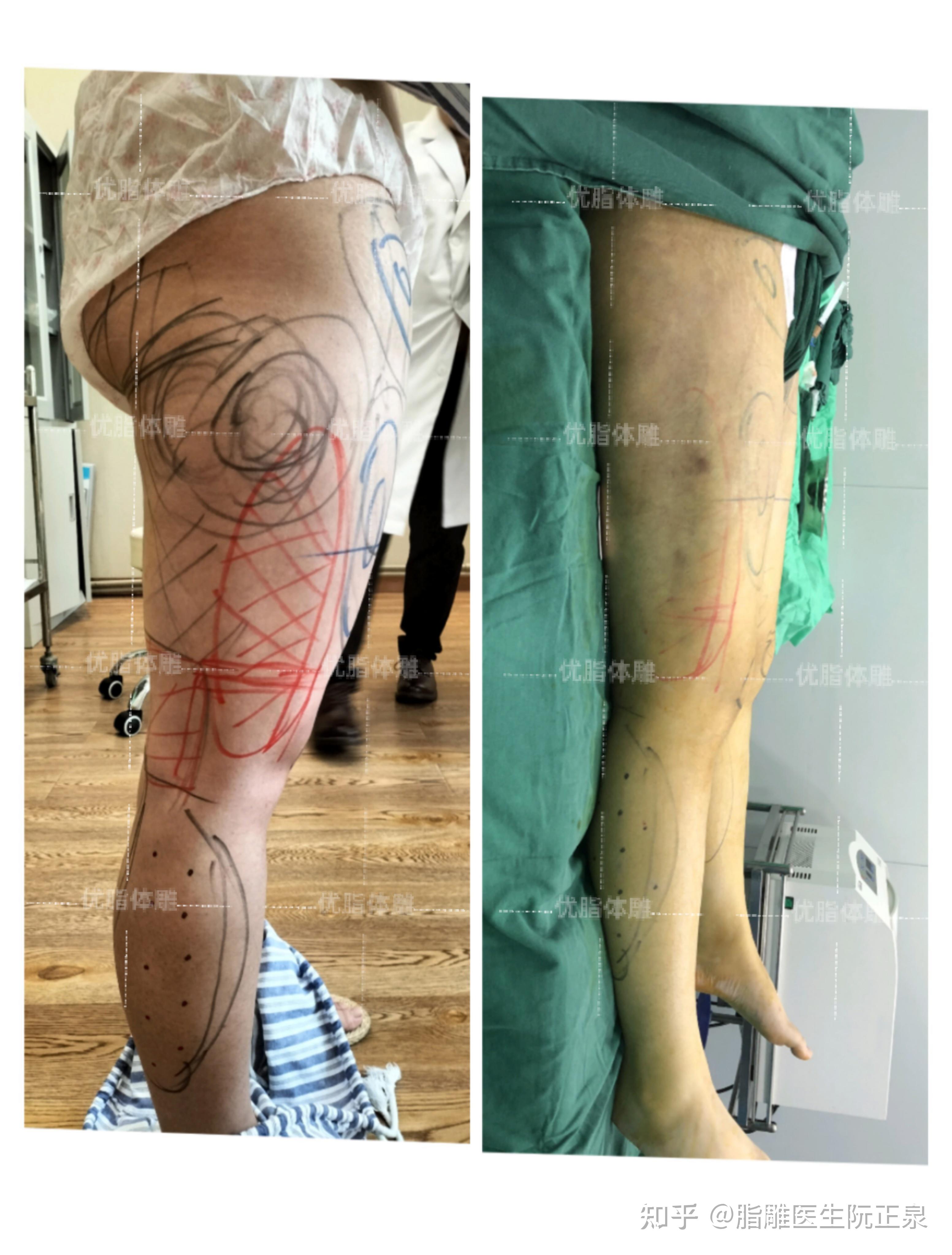 大腿吸脂手术价格大概是多少
