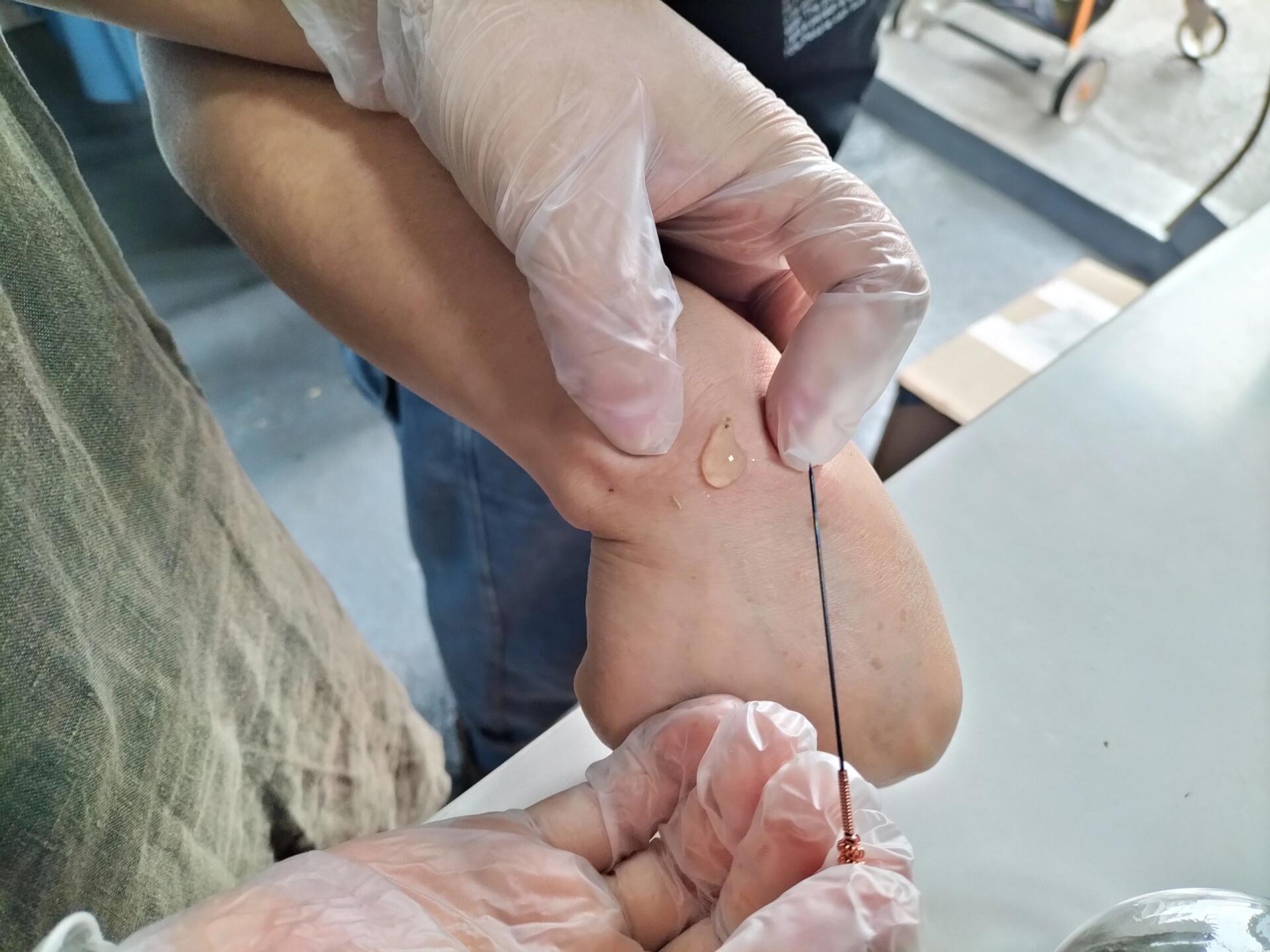 火针治疗腱鞘囊肿