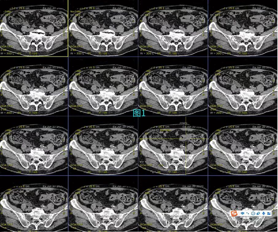 结肠癌影像图片图片