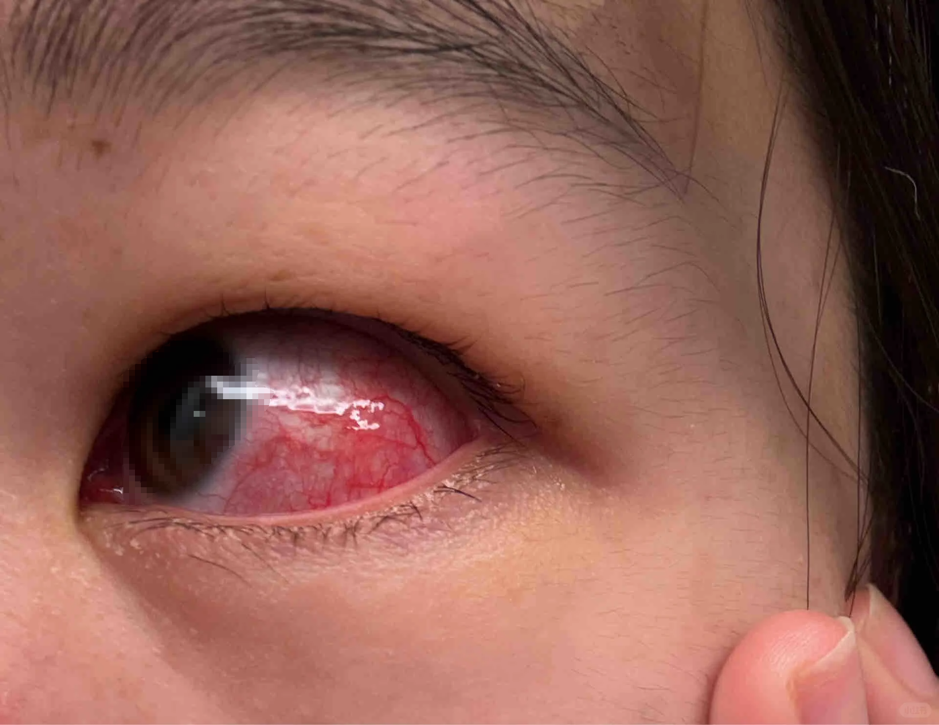 左眼眼白出现一片血红色,可能和疲劳,结膜炎或者眼睑炎有关