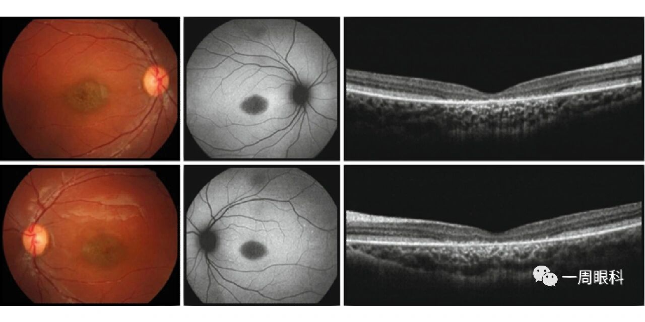 青少年性黄斑变性 青少年性黄斑变性