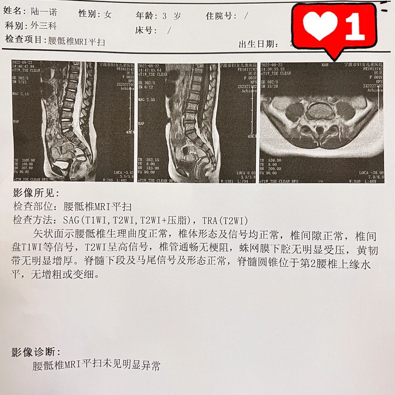 脊髓炎核磁共振图片