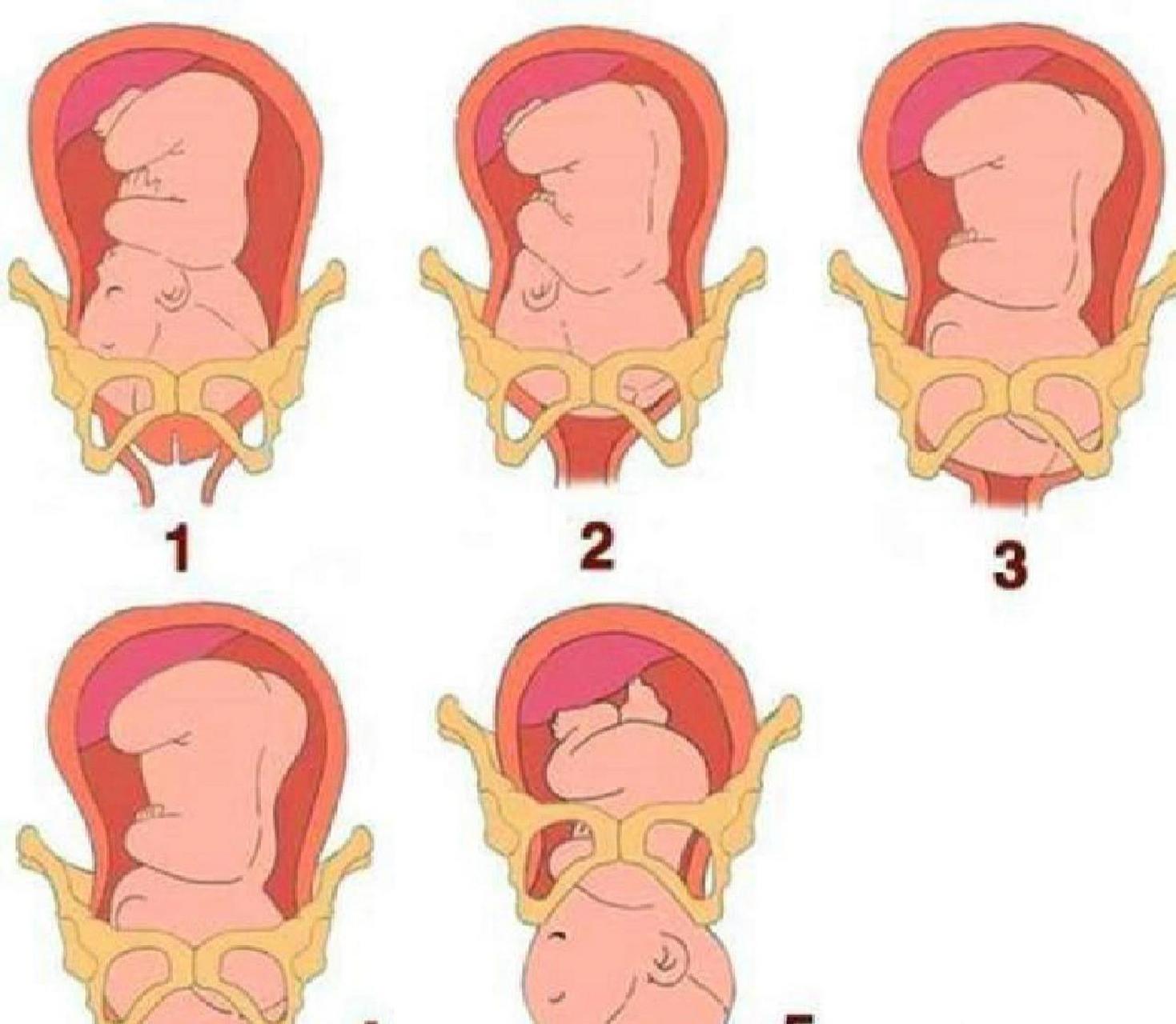 对于初次怀孕的女性来说,胎儿在待产期突然入盆或逐渐入盆的情况非常
