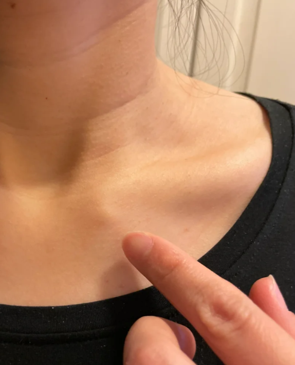 一吸气一动右边锁骨那里很疼怎么回事?