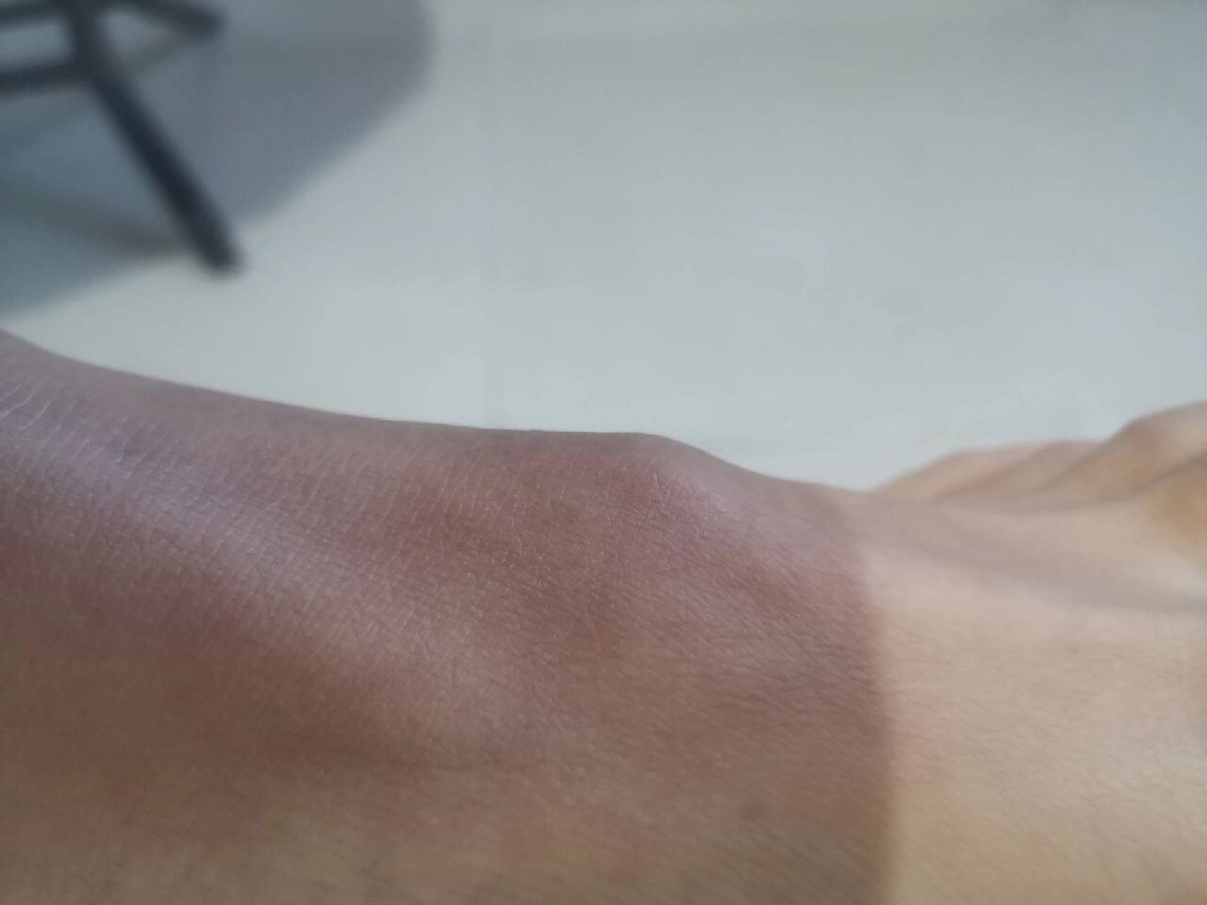 脚背上长了个硬包,有两年了,这是啥,怕怕 疫情第一年每天跑步 ,运动