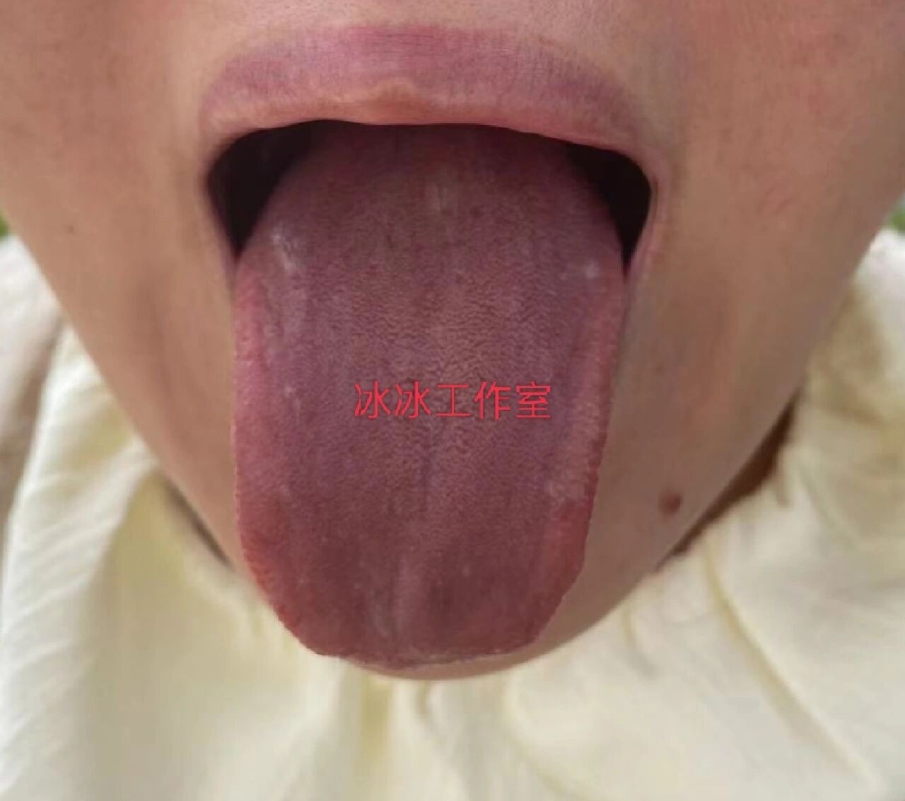 舌诊分析,舌头发紫,瘀血阻络