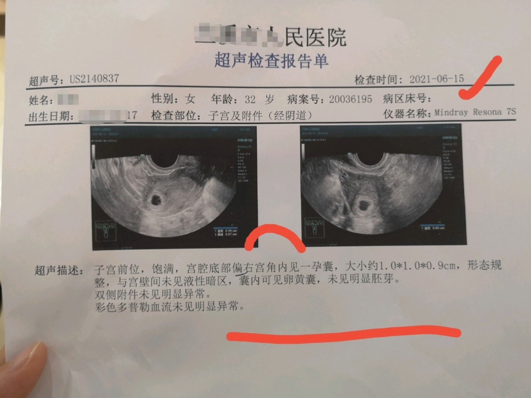 宫腔偏右侧图片