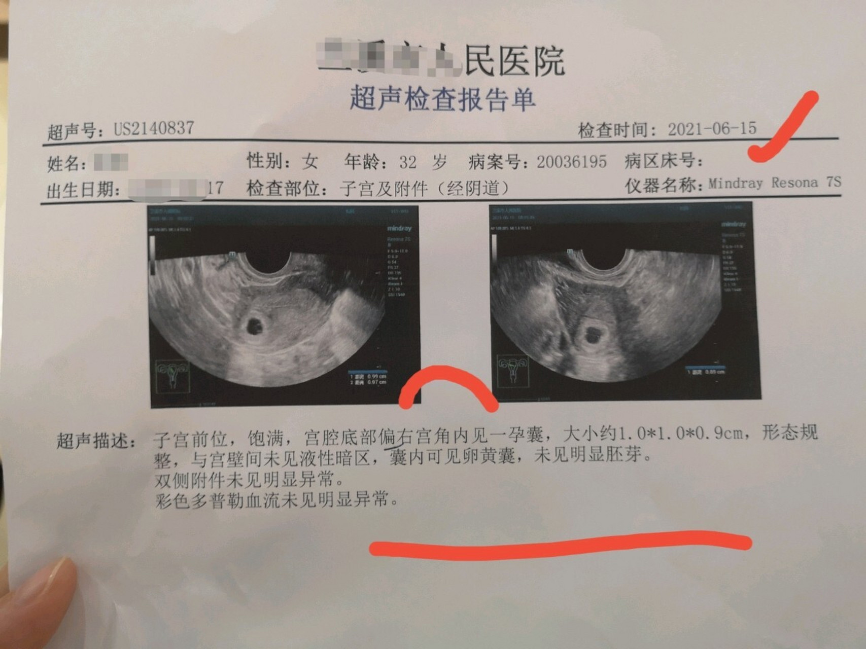 宫腔底部偏右宫角内 求问,有没有姐妹跟我一样的情况 末次月经5月1号