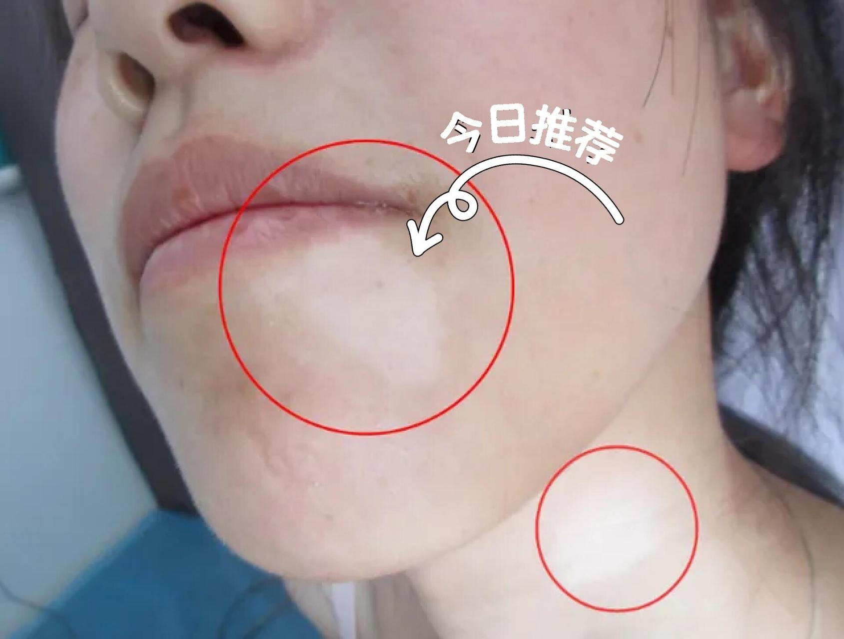 身上出现白斑分不清楚是不是白癜风,白癜风初期的症状表现是怎样的呢?